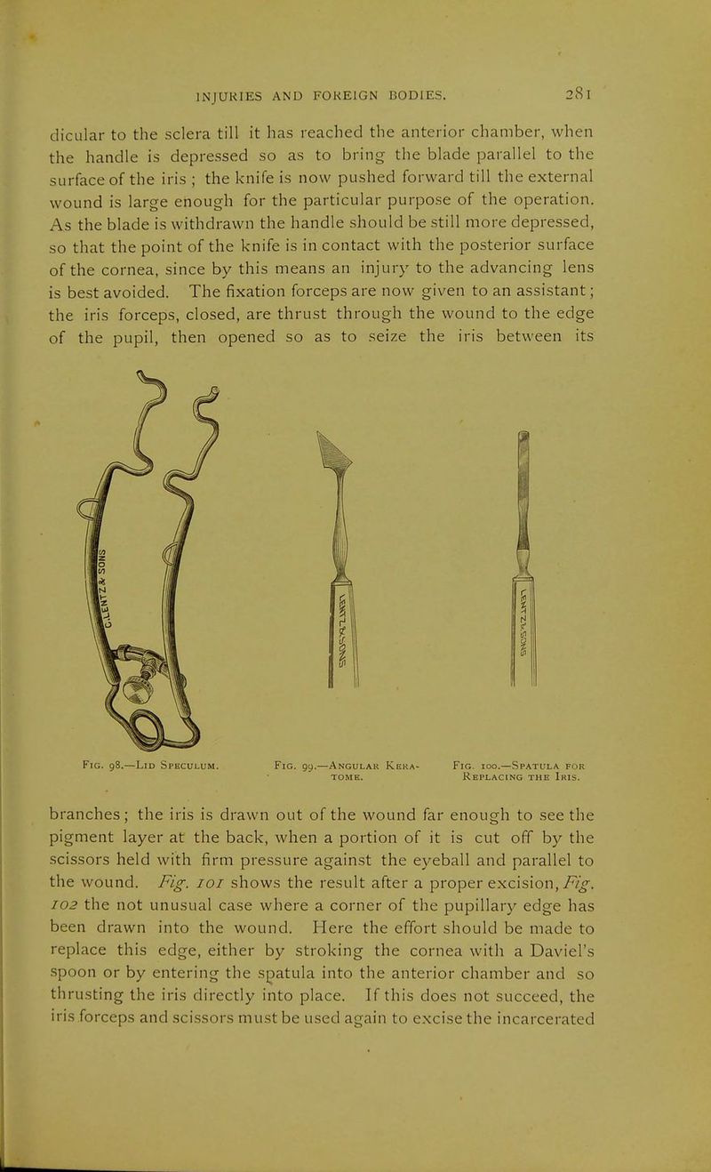 INJURIES AND FOREIGN BODIES. dicular to the sclera till it has reached the anterior chamber, when the handle is depressed so as to bring the blade parallel to the surface of the iris ; the knife is now pushed forward till the external wound is large enough for the particular purpose of the operation. As the blade is withdrawn the handle should be still more depressed, so that the point of the knife is in contact with the posterior surface of the cornea, since by this means an injury to the advancing lens is best avoided. The fixation forceps are now given to an assistant; the iris forceps, closed, are thrust through the wound to the edge of the pupil, then opened so as to seize the iris between its Fig. 98.—Lid Speculum. Fig. gy.—Angulak Keka- Fig. 100.—Spatula for TOME. Replacing the Iris. branches; the iris is drawn out of the wound far enough to see the pigment layer at the back, when a portion of it is cut off by the scissors held with firm pressure against the eyeball and parallel to the wound. Fig. loi shows the result after a proper excision,-F/^. 102 the not unusual case where a corner of the pupillary edge has been drawn into the wound. Here the effort should be made to replace this edge, either by stroking the cornea with a Daviel's spoon or by entering the sjpatula into the anterior chamber and so thrusting the iris directly into place. If this does not succeed, the iris forceps and scissors must be used again to excise the incarcerated