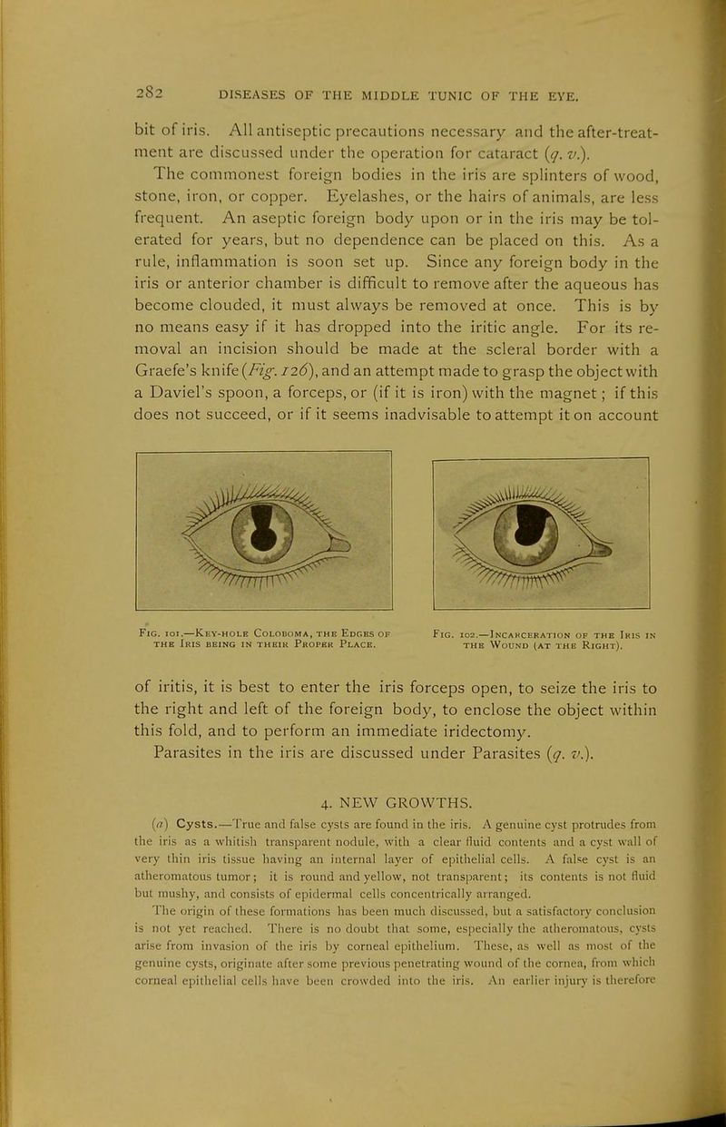 bit of iris. All antiseptic precautions necessary and the after-treat- ment are discussed under the operation for cataract {q. v). The commonest foreign bodies in the iris are splinters of wood, stone, iron, or copper. Eyelashes, or the hairs of animals, are less frequent. An aseptic foreign body upon or in the iris may be tol- erated for years, but no dependence can be placed on this. As a rule, inflammation is soon set up. Since any foreign body in the iris or anterior chamber is difficult to remove after the aqueous has become clouded, it must always be removed at once. This is by no means easy if it has dropped into the iritic angle. For its re- moval an incision should be made at the scleral border with a Graefe's knife (/^V. 126), and an attempt made to grasp the object with a Daviel's spoon, a forceps, or (if it is iron) with the magnet; if this does not succeed, or if it seems inadvisable to attempt it on account Fig. ioi.—Key-hole Colodoma, the Edges of Fig. 102.—Incakceration of the Ikis in THE Iris being in their Proper Place. the Wound (at the Right). of iritis, it is best to enter the iris forceps open, to seize the iris to the right and left of the foreign body, to enclose the object within this fold, and to perform an immediate iridectomy. Parasites in the iris are discussed under Parasites [q. t.). 4. NEW GROWTHS. (^7) Cysts.—True and false cysts are found in the iris. A genuine cyst protrudes from the iris as a whitish transparent nodule, with a clear fluid contents and a cyst wall of very thin iris tissue having an internal layer of epithelial cells. A false cyst is an atheromatous tumor; it is round and yellow, not transparent; its contents is not fluid but mushy, and consists of epidermal cells concentrically arranged. The origin of these formations has been much discussed, but a satisfactory conclusion is not yet reached. There is no doubt that some, especially the atheromatous, cysts arise from invasion of the iris by corneal epithelium. These, as well as most of the genuine cysts, originate after some previous penetrating wound of the cornea, from which corneal epithelial cells have been crowded into the iris. An earlier injuiy is therefore
