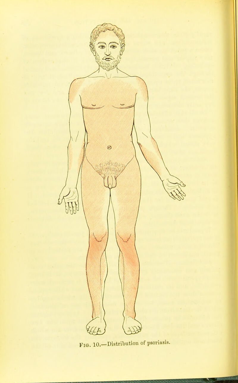 FlG. 10.—Distribution of psoriasis.