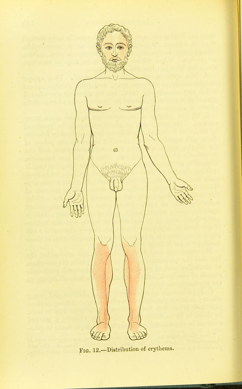 Fig. 12.—Distribution of erythema.