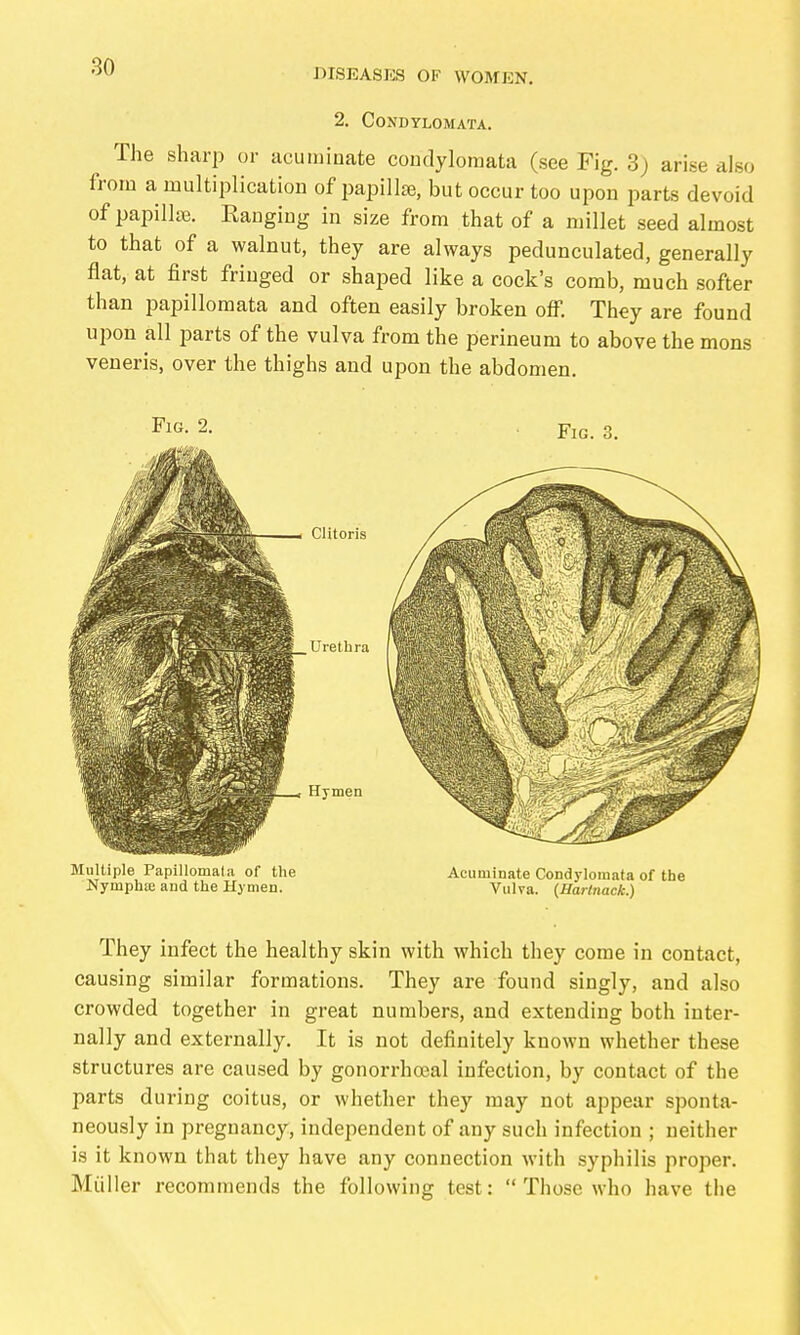 DISEASES OF WOMEN. 2. Condylomata. The sharp or acuminate condylomata (see Fig. 3) arise also from a multiplication of papillse, but occur too upon parts devoid of papillae. Eangiug in size from that of a millet seed almost to that of a walnut, they are always pedunculated, generally flat, at first fringed or shaped like a cock's comb, much softer than papillomata and often easily broken off. They are found upon all parts of the vulva from the perineum to above the mons veneris, over the thighs and upon the abdomen. Multiple Papillomata of the Acuminate Condylomata of the Nymphffi and the Hymen. Vulva. {Hartnack.) They infect the healthy skin with which they come in contact, causing similar formations. They are found singly, and also crowded together in great numbers, and extending both inter- nally and externally. It is not definitely known whether these structures are caused by gonorrhceal infection, by contact of the parts during coitus, or whether they may not appear sponta- neously in pregnancy, independent of any such infection ; neither is it known that they have any connection with syphilis proper. Mi;iller recommends the following test:  Those who have the