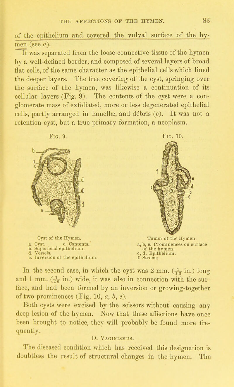 of the epithelium and covered the vulval surface of the hy- men (see a). It was separated from the loose connective tissue of the hymen by a well-defined border, and composed of several layers of broad flat cells, of the same character as the epithelial cells which lined the deeper layers. The free covering of the cyst, springing over the surface of the hymen, was likewise a continuation of its cellular layers (Fig. 9). The contents of the cyst were a con- glomerate mass of exfoliated, more or less degenerated epithelial cells, partly arranged in lamellae, and debris (c). It was not a retention cyst, but a true primary formation, a neoplasm. Fig. 9. Fig. 10. Cyst of the Hymen. a Cyst. c. Contents, b. Superficial epithelium. d. Vessels. e. Inversion of the epithelium. Tumor of the Hymen. a, b, e. Prominences on surface of the hymen, c, d. Epithelium, f. Stroma. In the second case, in which the cyst was 2 mm. in.) long and 1 mm. (Jg- in.) wide, it was also in connection with the sur- face, and had been formed by an inversion or growing-together of two prominences (Fig. 10, a, b, c). Both cysts were excised by the scissors without causing any deep lesion of the hymen. Now that these aflTections have once been brought to notice, they will probably be found more fre- quently. D. Vaginismus. The diseased condition which has received this designation is doubtless the result of structural changes in the hymen. The