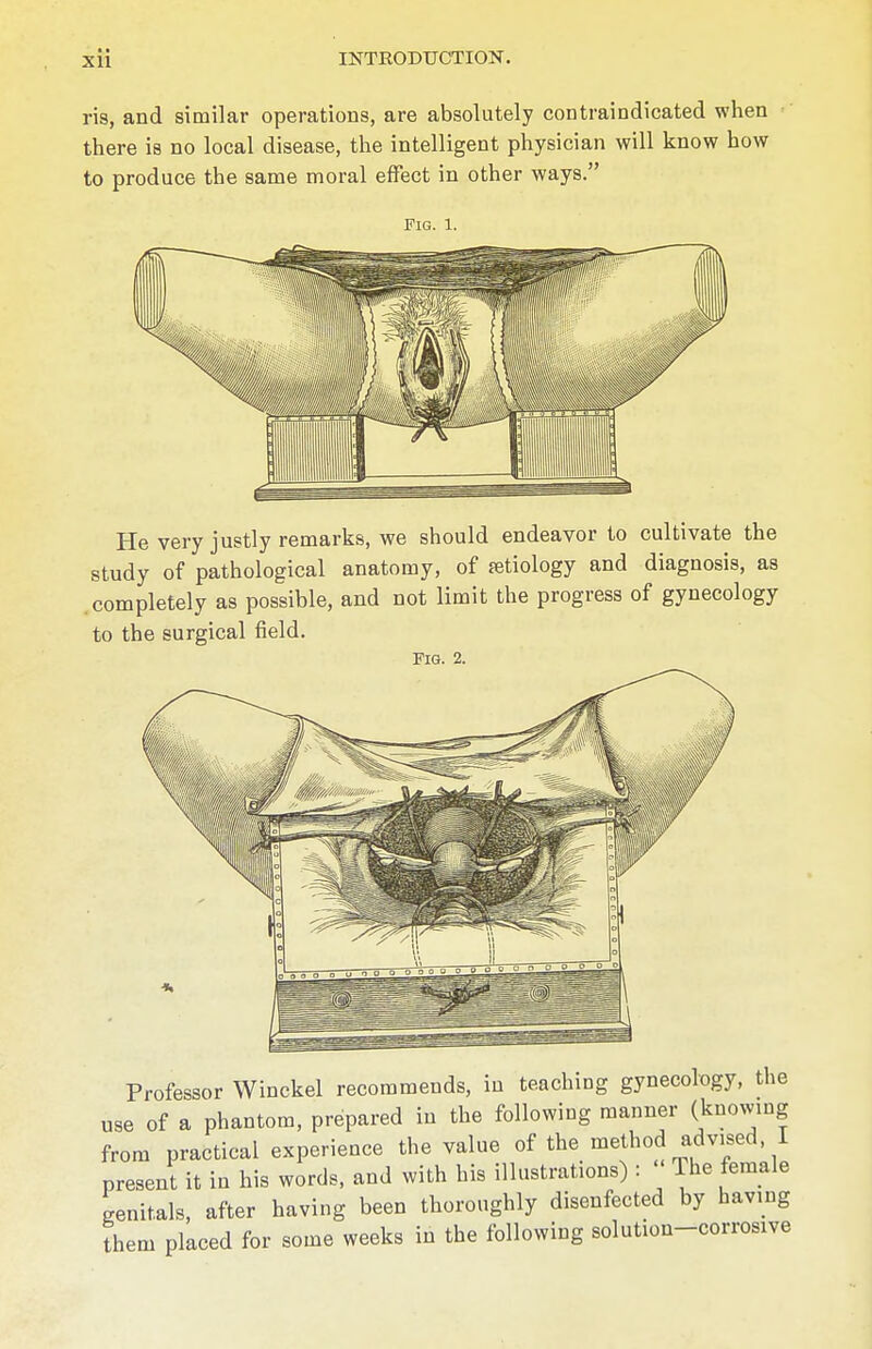 XU ria, and similar operations, are absolutely contraindicated when there is no local disease, the intelligent physician will know how to produce the same moral effect in other ways. Fig. 1. He very justly remarks, we should endeavor to cultivate the study of pathological anatomy, of fetiology and diagnosis, as .completely as possible, and not limit the progress of gynecology to the surgical field. Fig. 2. Professor Winckel recommends, in teaching gynecology, the use of a phantom, prepared in the following manner (knowing from practical experience the value of the method advised, I present it in his words, and with his illustrations) : « The female genitals, after having been thoroughly disenfected by having them placed for some weeks in the following solution-corrosive