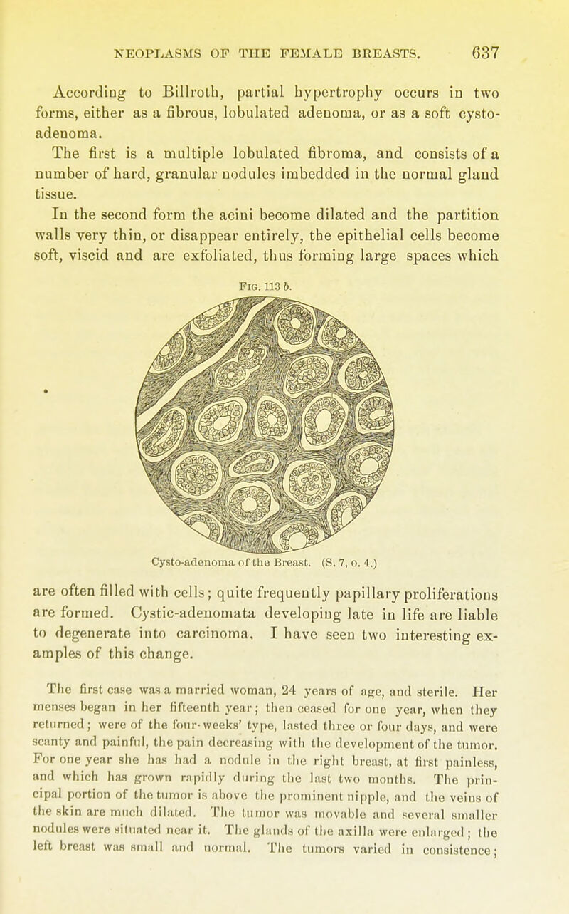 According to Billroth, partial hypertrophy occurs in two forms, either as a fibrous, lobulated adenoma, or as a soft cysto- adeuoma. The first is a multiple lobulated fibroma, and consists of a number of hard, granular nodules imbedded in the normal gland tissue. In the second form the acini become dilated and the partition walls very thin, or disappear entirely, the epithelial cells become soft, viscid and are exfoliated, thus forming large spaces which Fig. 113 b. Cysto-adenoma of the Breast. (S. 7, o. 4.) are often filled with cells; quite frequently papillary proliferations are formed. Cystic-adenomata developing late in life are liable to degenerate into carcinoma, I have seen two interesting ex- amples of this change. The first case was a married woman, 24 years of age, and sterile. Her menses began in her fifteenth year; then ceased for one year, when they returned; were of the four-weeks' type, lasted three or four days, and were scanty and painful, the pain decreasing with the development of the tumor. For one year she has had a nodule in the right breast, at first painless, and which has grown rapidly during the last two months. The prin- cipal portion of the tumor is above the prominent nipple, and the veins of the skin are much dilated. The tumor was movable and several smaller nodules were situated near it. The glands of the axilla were enlarged ; the left breast was small and normal. The tumors varied in consistence;