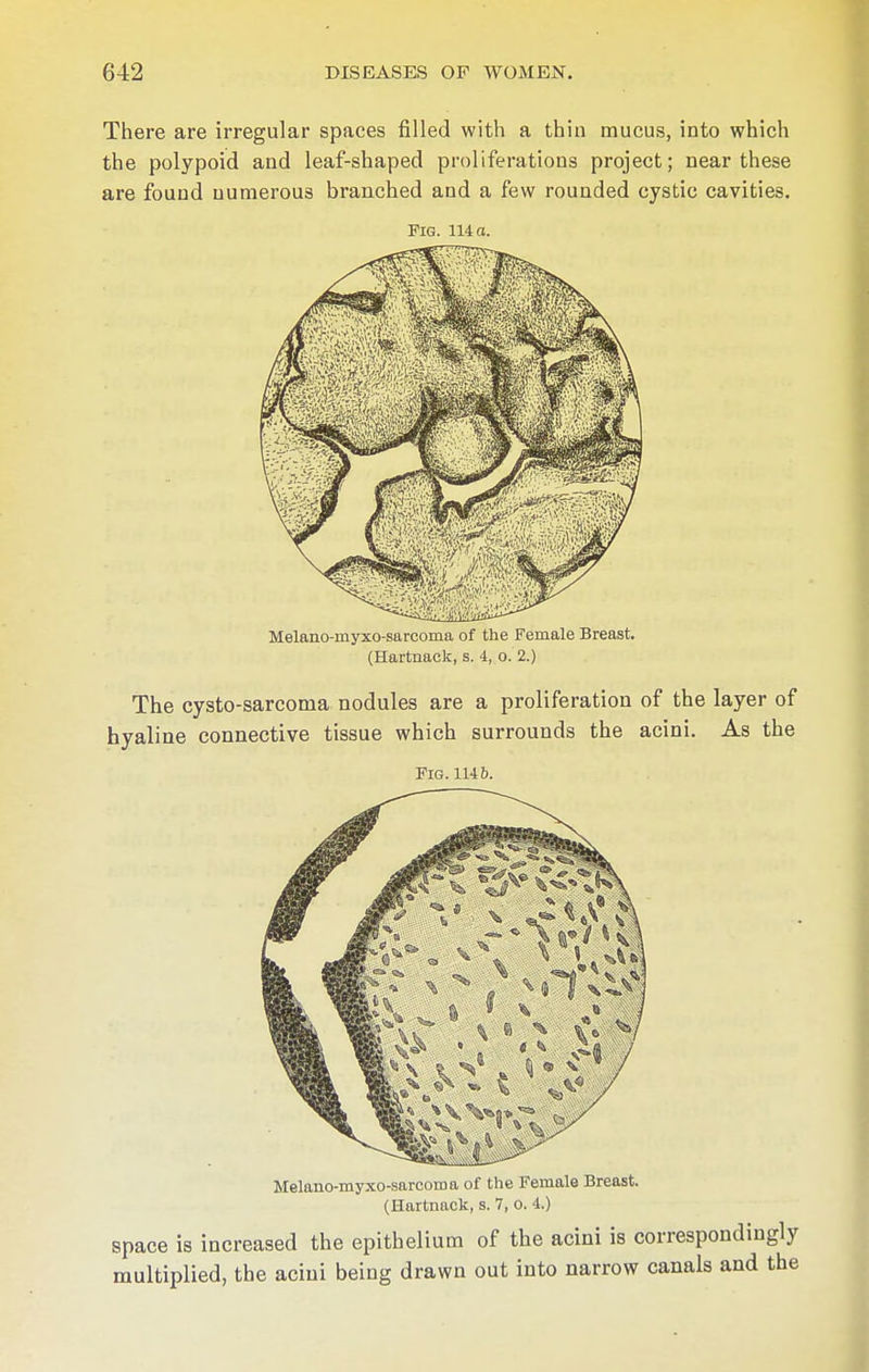 There are irregular spaces filled with a thin mucus, into which the polypoid and leaf-shaped proliferations project; near these are found numerous branched and a few rounded cystic cavities. Fig. 114 o. Melano-myxo-sarcoma of the Female Breast. (Hartnack, s. 4, o. 2.) The cysto-sarcoma nodules are a proliferation of the layer of hyaline connective tissue which surrounds the acini. As the Fig. 114 6. Melano-myxo-sarcoma of the Female Breast. (Hartnack, s. 7, o. 4.) space is increased the epithelium of the acini is correspondingly multiplied, the aciui being drawn out into narrow canals and the