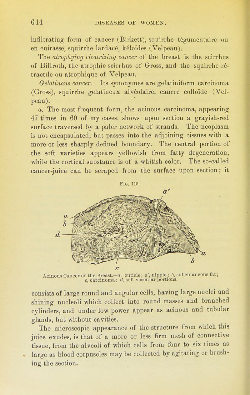 infiltrating form of cancer (Birkett), squirrhe tegumentaire ou en cuirasse, squirrhe lardace, keloides (Velpeau). The atrophying cicatrizing cancer of the breast is the scirrhus of Billroth, the atrophic scirrhus of Gross, and the squirrhe re- tractile ou atrophique of Velpeau. Gelatinous cancer. Its synonymes are gelatiniform carcinoma (Gross), squirrhe gelatineux alveolaire, cancre colloide (Vel- peau). a. The most frequent form, the acinous carcinoma, appearing 47 times in 60 of my cases, shows upon section a grayish-red surface traversed by a paler network of strands. The neoplasm is not encapsulated, but passes into the adjoining tissues with a more or less sharply defined boundary. The central portion of the soft varieties appears yellowish from fatty degeneration, while the cortical substance is of a whitish color. The so-called cancer-juice can be scraped from the surface upon section; it Fig. 115. a' Acinous Cancer of the Breast— a, cuticle; o', nipple ; b, subcutaneous fat; c, carcinoma; d, soft vascular portions. consists of large round and angular cells, having large nuclei and shining nucleoli which collect into round masses and branched cylinders, and under low power appear as acinous and tubular glands, but without cavities. The microscopic appearance of the structure from which this juice exudes, is that of a more or less firm mesh of connective tissue, from the alveoli of which cells from four to six times as large as blood corpuscles may be collected by agitating or brush- ing the section.