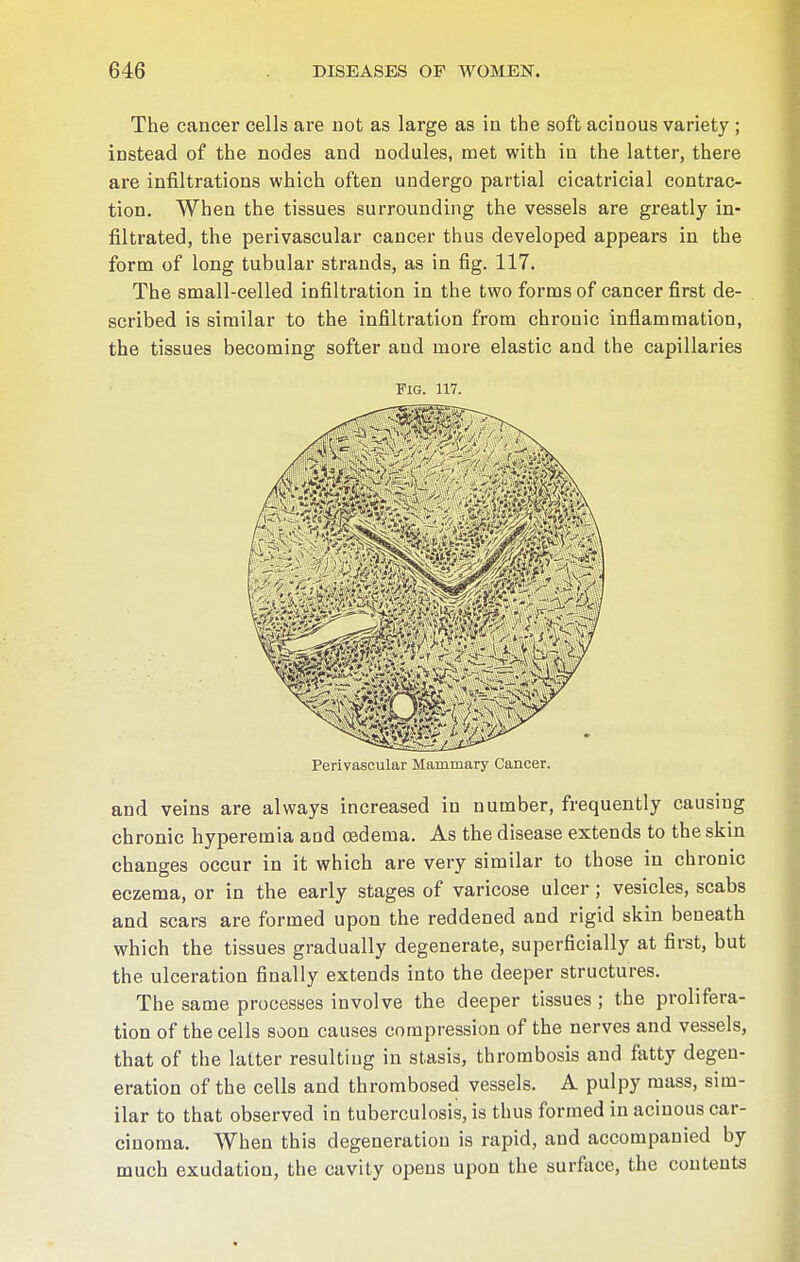 The cancer cells are not as large as in the soft acinous variety ; instead of the nodes and nodules, met with in the latter, there are infiltrations which often undergo partial cicatricial contrac- tion. When the tissues surrounding the vessels are greatly in- filtrated, the perivascular cancer thus developed appears in the form of long tubular strands, as in fig. 117. The small-celled infiltration in the two forms of cancer first de- scribed is similar to the infiltration from chronic inflammation, the tissues becoming softer and more elastic and the capillaries Fig. 117. Perivascular Mammary Cancer, and veins are always increased in number, frequently causing chronic hyperemia and oedema. As the disease extends to the skin changes occur in it which are very similar to those in chronic eczema, or in the early stages of varicose ulcer; vesicles, scabs and scars are formed upon the reddened and rigid skin beneath which the tissues gradually degenerate, superficially at first, but the ulceration finally extends into the deeper structures. The same processes involve the deeper tissues ; the prolifera- tion of the cells soon causes compression of the nerves and vessels, that of the latter resulting in stasis, thrombosis and fatty degen- eration of the cells and thrombosed vessels. A pulpy mass, sim- ilar to that observed in tuberculosis, is thus formed in acinous car- cinoma. When this degeneration is rapid, and accompanied by much exudation, the cavity opens upon the surface, the contents