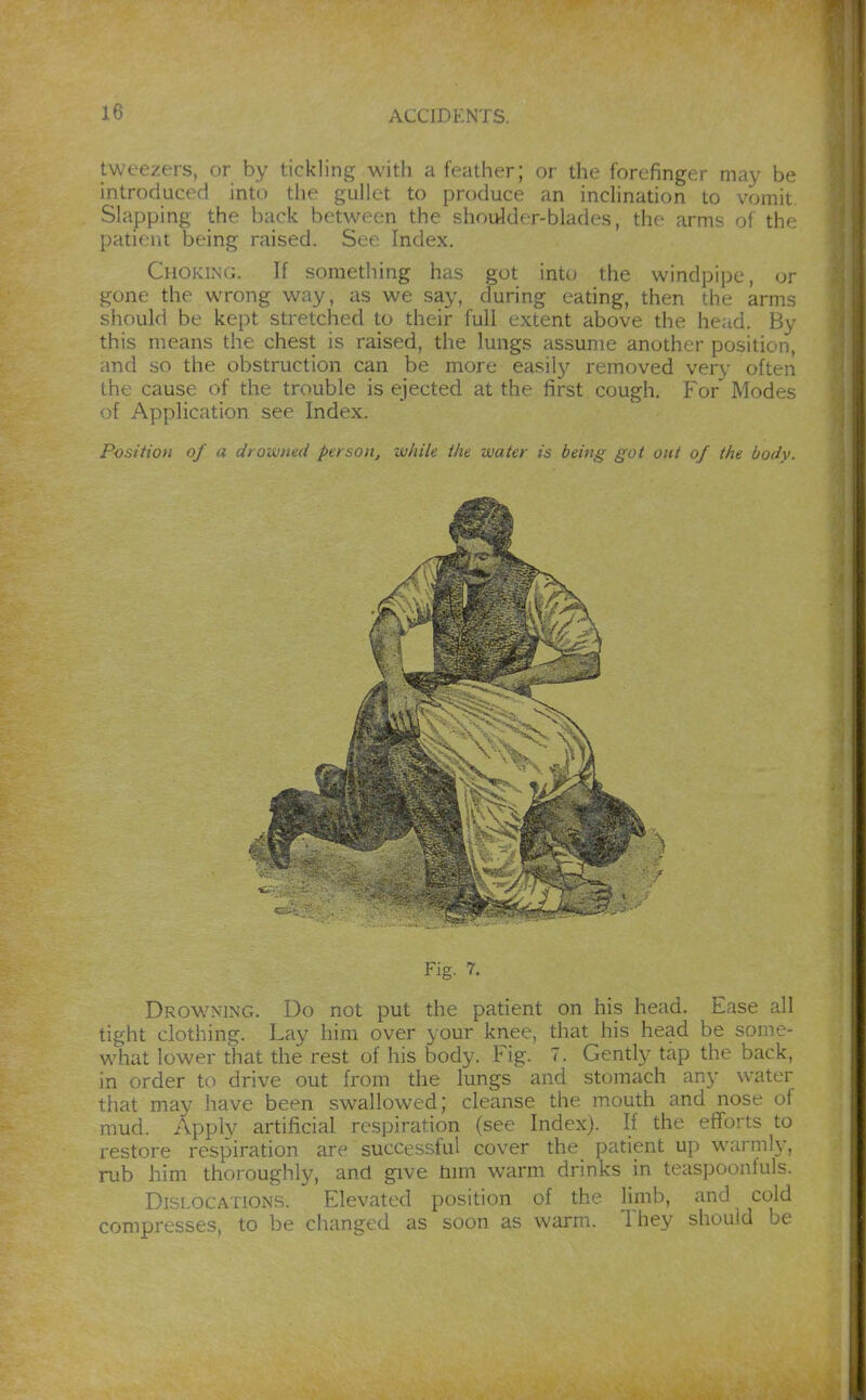 tweezers, or by tickling with a feather; or the forefinger may be introduced into the gullet to produce an incUnation to vomit Slapping the back between the shoulder-blades, the arms of thf patient being raised. See Index. Choking. If something has got into the windpipe, or gone the wrong way, as we say, during eating, then the arms should be kept stretched to their full extent above the head. By this means the chest is raised, the lungs assume another position, and so the obstruction can be more easil3r removed very often the cause of the trouble is ejected at the first cough. For Modes of Application see Index. Position of a drowned person, while the water is being got out of the body. Fig. 7. Drowning. Do not put the patient on his head. Ease all tight clothing. Lay him over your knee, that his head be some- what lower that the rest of his body. Fig. 7. Gently tap the back, in order to drive out from the lungs and stomach any water that may have been swallowed; cleanse the mouth and nose of mud. Apply artificial respiration (see Index). If the efforts to restore respiration are successful cover the patient up warmly, rub him thoroughly, and give tum warm drinks in teaspoonfuls. Dislocations. Elevated position of the hmb, and cold compresses, to be changed as soon as warm. They should be