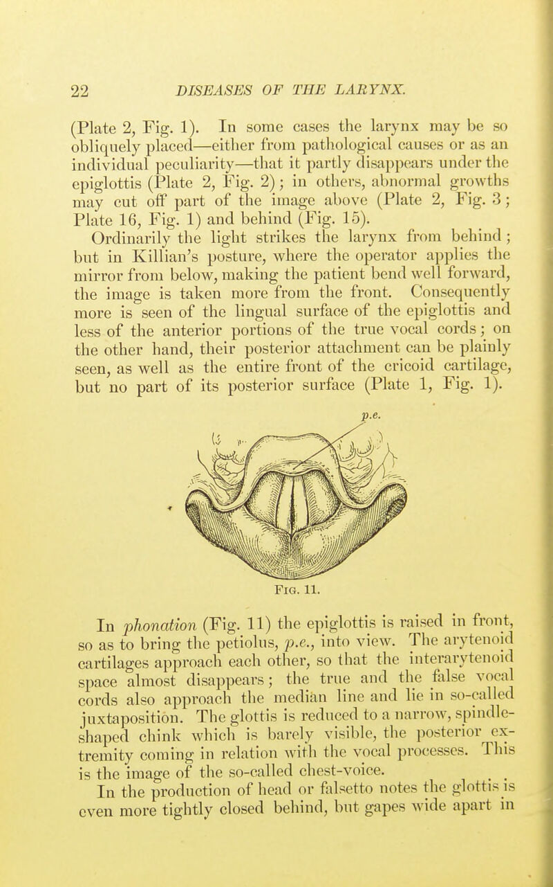 (Plate 2, Fig. 1). In some cases the larynx may be so obliquely placed—either from pathological causes or as an individual peculiarity—that it partly disappears under the epiglottis (Plate 2, Fig. 2); in others, abnormal growths may cut olf part of the image above (Plate 2, Fig. 3; Plate 16, Fig. 1) and behind (Fig. 15). Ordinarily the light strikes the larynx from behind ; but in Killian's posture, where the operator applies the mirror from below, making the patient bend well forward, the image is taken more from the front. Consequently more is seen of the lingual surface of the epiglottis and less of the anterior portions of the true vocal cords; on the other hand, their posterior attachment can be plainly seen, as well as the entire front of the cricoid cartilage, but no part of its posterior surface (Plate 1, Fig. 1). p.e. Fig. 11. In Phonation (Fig. 11) the epiglottis is raised in front, so as to bring the petiolus, p.e., into view. The arytenoid cartilages approach each other, so that the interarytenoid space almost disappears; the true and the false vocal cords also approach the median line and lie in so-called juxtaposition. The glottis is reduced to a narrow, spindle- shaped chink which is barely visible, the posterior ex- tremity coming in relation with the vocal processes. This is the image of the so-called chest-voice. In the production of head or falsetto notes the glottis is even more tightly closed behind, but gapes wide apart in