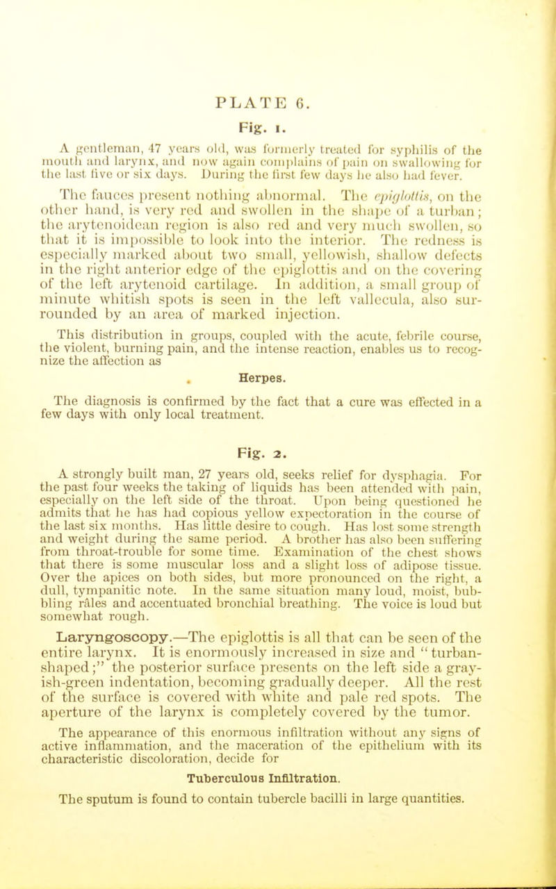 Fig. I. A gentleman, 47 years old, was loinierly treated for syphilis of the mouth and larynx, and now again comi)lains of pain on swallowing for the last hve or six days. During the first few days lie also had fever. The fouces present nothing ahnormal. The epiglotds, on the other hand, is very red and swoUen in the shapc of a turhan; the arytenoidcan region is also red and very niucli swollen, so that it is inipossihle to look into the interior. The redness is especially marked about two small, yellowish, shallow defects in the right anterior edge of the epiglottis and on the covering of the left arytenoid cartilage. In addition, a small group of minute whitish spots is seen in the left vallecula, also sur- rounded by an area of marked injection. This distribution in groups, coupled with the acute, febrile course, the violent, burning pain, and the intense reaction, enables us to recog- nize the alTection as Herpes. The diagnosis is confirmed by the fact that a cure was effected in a few days with only local treatment. Fig. 2. A strongly built man, 27 years old, seeks relief for dysphagia. For the past four weeks the taking of liquids has been attended with pain, especially on the left side of the throat. Upon being questioned he admits that he has had copious yellow expectoration in the course of the last six months. Has little desire to cough. Has lost some strength and weight during tlie same period. A brother has also been suffering from throat-trouble for some time. Examination of the chest shows that there is some muscular loss and a slight loss of adipose tissue. Over the apices on both sides, but more pronounced on the right, a dull, tympanitic note. In the same situation many loud, moist bub- bling rales and accentuated bronchial breathing. The voice is loud but somewhat rough. Laryngoscopy.—The epiglottis is all that can be seen of the entire larynx. It is enormously increased in size and  turban- shaped; the posterior surface presents on the left side a gray- ish-green indentation, becoming gradually deeper. All the rest of the surfoce is covered with white and pale red spots. The aperture of the larynx is completely covered by tlie tumor. The appearance of this enormous infiltration without any signs of active inflammation, and the maceration of the epithelium with its characteristic discoloration, decide for Tuberculous Infiltration. The sputum is found to contain tubercle bacilli in large quantities.