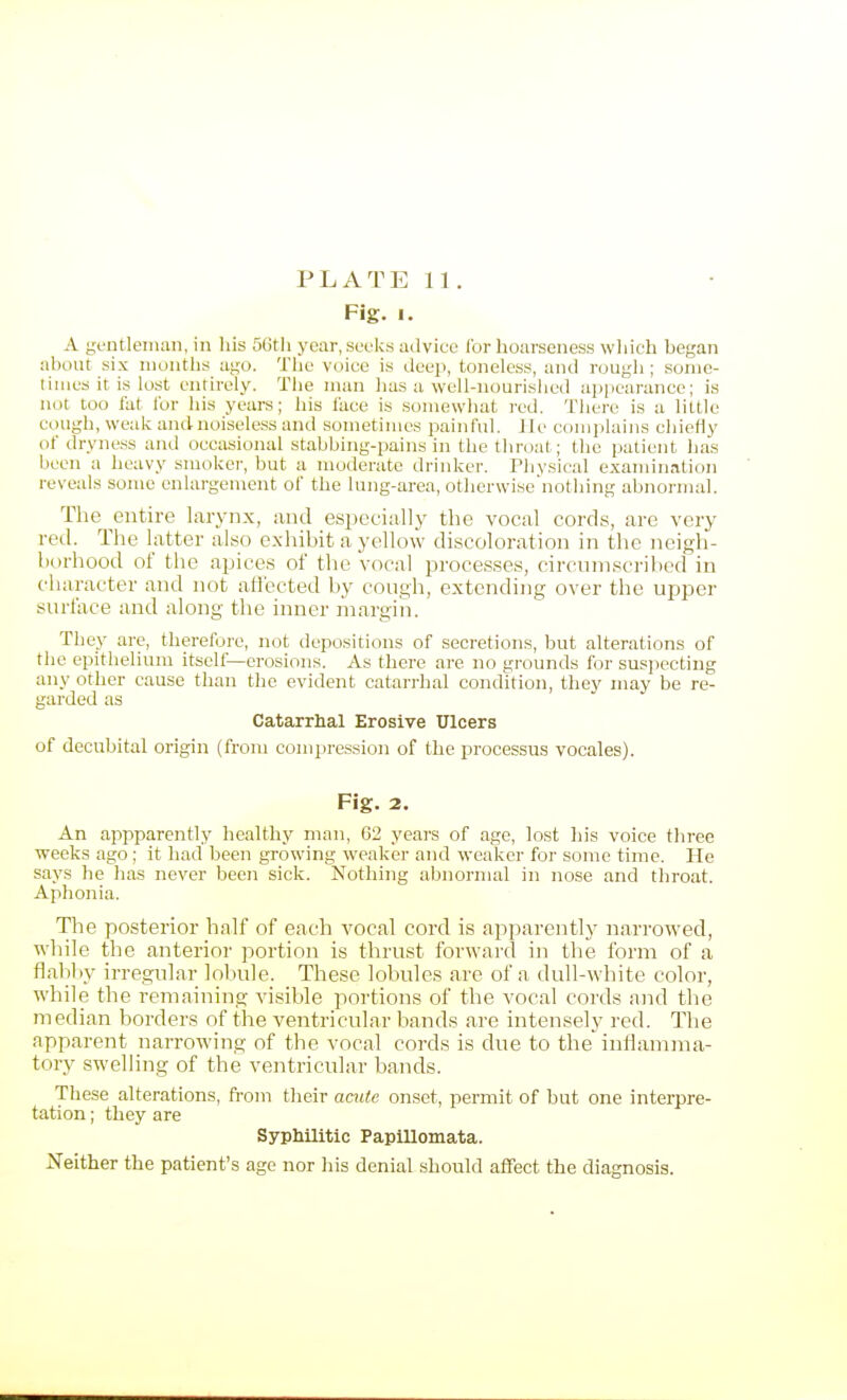 Fig. 1. A gentleman, in Iiis 56tli year, seeks ailvice for hoarseness wliieh began about six months ai,'0. The voice is deep, toneless, and rough ; some- times it is lost entirely. The man lias a well-nourisiied appearance; is not too fat for his years; his lace is somewhat red. There is a little cough, weak and noiseless and sometimes painful. Jle complains chiefly of dryness and occasional stabbing-pains in the throat; the patient has been a heavy smoker, but a moderate drinker. I'livsical examination reveals some enlargement of the lung-area, otherwisenothing abnormal. The entire hirynx, and especially the vocal cords, are very red. The latter also exhibit a yellow discoloration in the neigh- borhood of the apices of the vocal processes, circnniscribed in character and not aifected by cough, extending over the upper surface and along the inner margin. They are, therefore, not depositions of secretions, but alterations of the epithelium itself—erosions. As there are no grounds for suspecting any other cause than the evident catarrhal condition, they may be re- garded as Catarrhal Erosive Ulcers of decubital origin (from compression of the processus vocales). Fig. 2. An appparently healthy man, 62 years of age, lost his voice tliree weeks ago ; it had been growing weaker and weaker for some time. He says he has never been sick. Nothing abnormal in nose and throat. Aphonia. The posterior half of each vocal cord is apparently narrowed, wliile the anterior portion is thrust forward in the form of a flal)by irregular lolmle. These lobules are of a dull-white color, while the remaining visible portions of the vocal cords and the median borders of the ventricular bands are intensely red. The apparent narrowing of the vocal cords is due to the inflamma- tory swelling of the ventricular bands. Th ese alterations, from their acute onset, permit of but one interpre- tation ; they are Syphilitic PapUlomata. Neither the patient's age nor Iiis denial should affect the diagnosis.