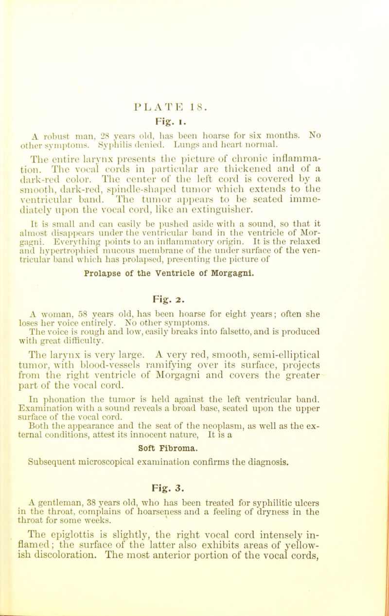 Fig. I. A robust man, 28 years old, has been lioarse for six months. No other syiiiptonis. Syphilis denied. Lungs and heart normal. The entire hirj'iix presents the picture of chronic inflamma- tion. The vocal cords in particular are thickened and of a dark-red color. The center of the left cord is covered by a smooth, dark-red, spindle-shaped tmnor which extends to the ventricular band. The tmnor appears to be seated imme- diately upon the vocal cord, like an extinguisher. It is small and can easily be pushed aside with a sound, so that it almost disappears under the ventricular band in the ventricle of Mor- gagni. Everything points to an intlanimatory origin. It is tlie relaxed and hypertrojihied mucous membrane of the under surface of the ven- tricular band which has prolapsed, presenting the picture of Prolapse of the Ventricle of Morgagni. Fig. 2. A woman, 58 years old, has been hoarse for eight years; often she loses her voice entirely. No other symptoms. The voice is rough and low, easily breaks into falsetto, and is produced with great difficulty. The larynx is very large. A very red, smooth, semi-elliptical tumor, with blood-vessels ramifying over its surface, projects from the right ventricle of Morgagni and covers the greater- part of the vocal cord. In Phonation the tumor is held against the left ventricular band. Examination with a sound reveals a broad base, seated upon the upper surface of the vocal cord. Both the appearance and the seat of the neoplasm, as well as the ex- ternal conditions, attest its innocent nature. It is a Soft Fibroma. Subsequent microscopical examination confirms the diagnosis. Fig. 3. A gentleman, 38 years old, who has been treated for syphilitic ulcers in the throat, complains of hoarseness and a feeling of dryness in the throat for some weeks. The epiglottis is slightly, the right vocal cord intensely in- flamed ; the surface of the latter also exhibits areas of yellow- ish discoloration. The most anterior portion of the vocal cords,