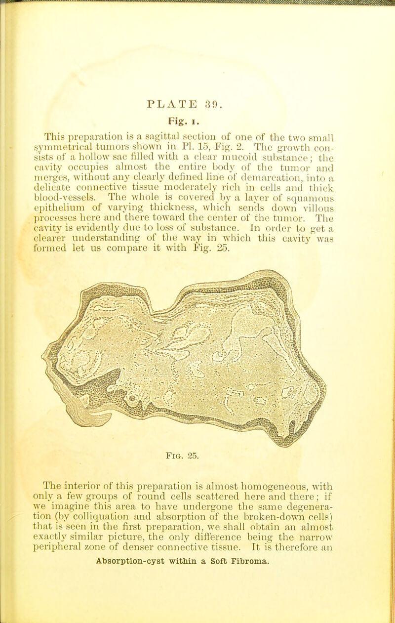 Fig. I. This preparation is a sagittal section of one of the two small synunetrieal tumors shown in PI. 15, Fig. 2. The growth con- sists of a Iiollow sac hlled with a clear mucoid substance; the cavity occupies almost the entire body of the tumor and merges, without any clearly delined line of demarcation, into a delicate connective tissue moderately rich in cells and thick blood-vessels. The whole is covered by a layer of squamous epithelium of varying thickness, which sends down villous processes here and there toward the center of the tumor. The cavity is evidently due to loss of substance. In order to get a clearer understanding of the way in which this cavity was formed let us compare it with Fig. 25. Fig. 25. The interior of this preparation is almost homogeneous, with only a few groups of round cells scattered here and there; if we imagine this area to have undergone the same degenera- tion (by colliquation and absorption of the broken-down cells) that is seen in the first preparation, we shall obtain an almost exactly similar picture, the only diflerence being the narrow peripheral zone of denser connective tissue. It is therefore an Absorption-cyst witMn a Soft Fibroma.