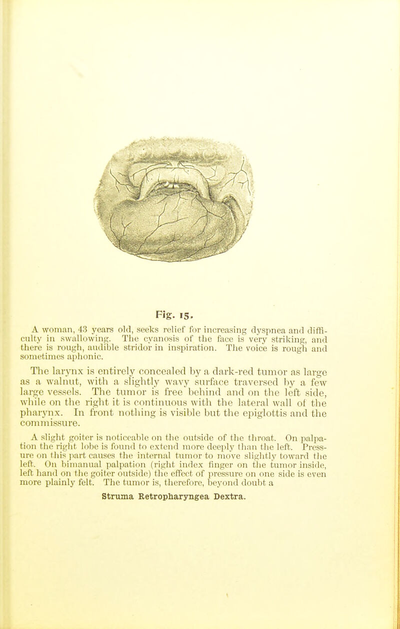 A woman, 43 years old, seeks relief for increasing dyspnea and diffi- culty in swallowing. The cyanosis of the face is very striking, and there is rough, audible stridor in inspiration. The voice is rough and sometimes aphonic. The larynx is entirely concealed by a dark-red tumor as large as a walnut, with a slightly wavy surface traversed by a few large vessels. The tumor is free behind and on the left side, while on the right it is continuous with the lateral wall ot the pharynx. In front nothing is visible but the epiglottis and the commissure. A slight goiter is noticeable on the outside of the throat. On palpa- tion the right lobe is found to extend more deeply than the left. Press- ure on this part causes the internal tumor to move sliglitly toward the left,. On bimanual palpation (right inde.x: finger on tlie tumor inside, left hand on the goiter outside) the effect of pressure on one side is even more plainly felt. The tumor is, therefore, beyond doubt a Struma Retropharyngea Dextra.