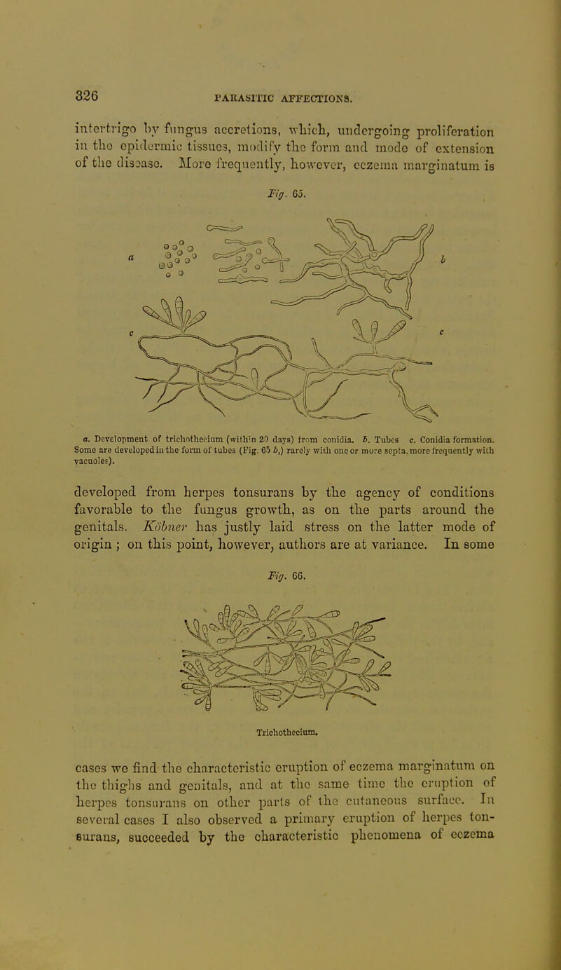 intertrigo by fungus accretions, which, undergoing proliferation in the epidermic tissues, modify the form and mode of extension of the dissase. More frequently, however, eczema marginatum is Fig. 65. a. Development of trichotheoium (within 2D days) from conidia. 5. Tubes e. Conidia formation. Some are developed in the form of tubes (Fig. 65 £,) rarely with one or more septa, more frequently with vacuoles). developed from herpes tonsurans by the agency of conditions favorable to the fungus growth, as on the parts around the genitals. Kühner has justly laid stress on the latter mode of origin ; on this point, however, authors are at variance. In some Fig. 66. Trichothccium. cases we find the characteristic eruption of eczema marginatum on the thighs and genitals, and at the same time the eruption of herpes tonsurans on other parts of the cutaneous surface. In several cases I also observed a primary eruption of herpes ton- surans, succeeded by the characteristic phenomena of eczema