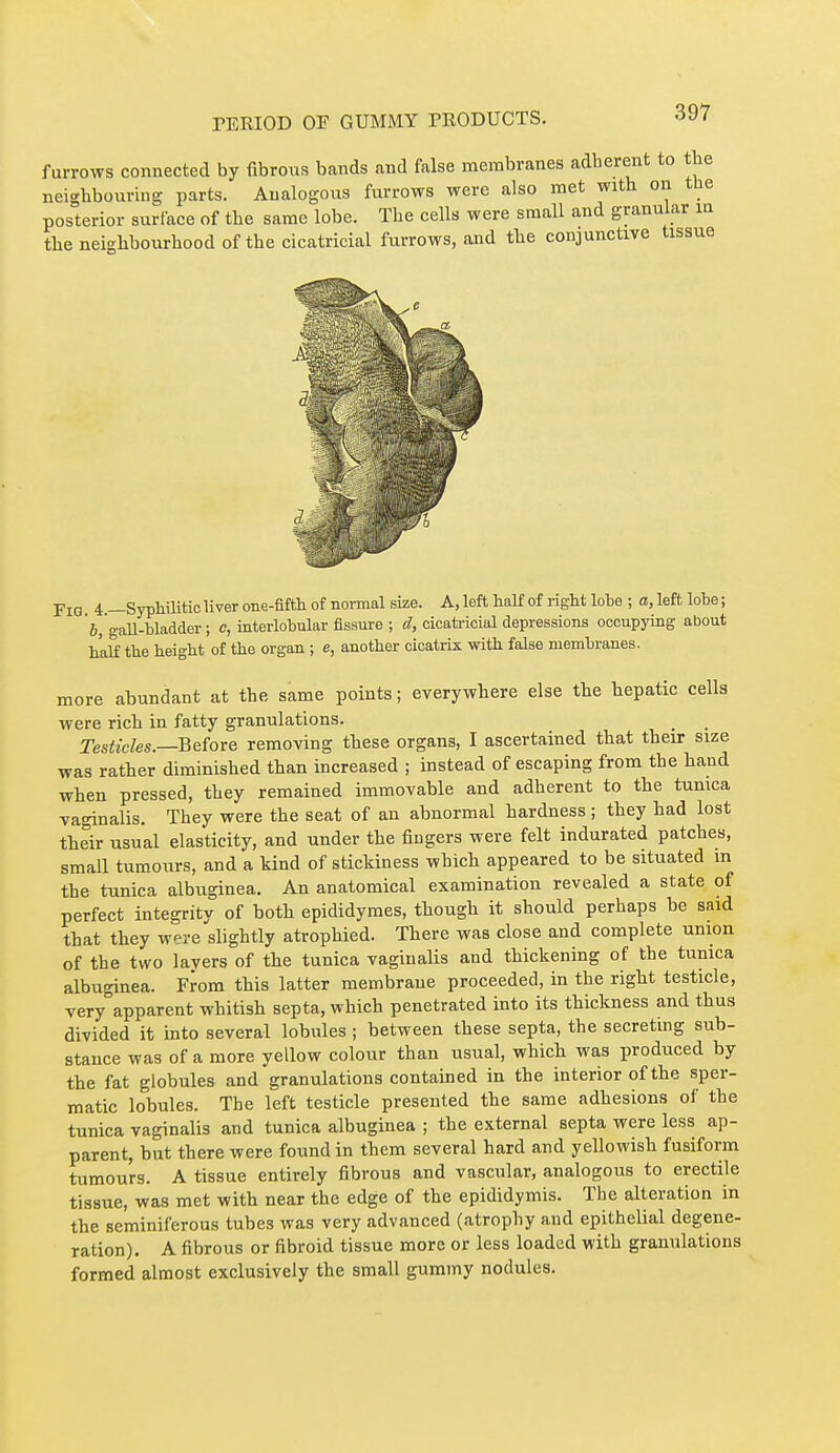 furrows connected by fibrous bands and false membranes adherent to the neighbouring parts. Analogous furrows were also met with on the posterior surface of the same lobe. The cells were small and granular in the neighbourhood of the cicatricial furrows, and the conjunctive tissue Fig 4 —SyphUitic liver one-fifth of noiTaal size. A, left half of right lobe ; a, left lobe ; 6, gaU-bladder ; c, interlobular fissure ; d, cicatricial depressions occupying about half the height of the organ ; e, another cicatrix with false membranes. more abundant at the same points ; everywhere else the hepatic cells ■were rich in fatty granulations. Testicles.—Before removing these organs, I ascertained that their size was rather diminished than increased ; instead of escaping from the hand when pressed, they remained immovable and adherent to the tunica vaginalis. They were the seat of an abnormal hardness ; they had lost tbeir usual elasticity, and under the fingers were felt indurated patches, small tumours, and a kind of stickiness which appeared to be situated m the tunica albuginea. An anatomical examination revealed a state of perfect integrity of both epididymes, thougb it should perhaps be said that they were slightly atrophied. There was close and complete union of the two lavers of the tunica vaginalis and thickening of the tunica albuoinea. From this latter membrane proceeded, in the right testicle, very°apparent whitish septa, which penetrated into its thickness and thus divided it into several lobules ; between these septa, the secretmg sub- stance was of a more yellow colour than usual, whicb was produced by the fat globules and granulations contained in the interior of the sper- matic lobules. The left testicle presented the same adhesions of the tunica vaginalis and tunica albuginea ; the external septa were less ap- parent, but there were found in them several hard and yellowish fusiform tumours. A tissue entirely fibrous and vascular, analogous to erectile tissue, was met with near the edge of the epididymis. The alteration in the seminiferous tubes was very advanced (atrophy and epithelial degene- ration). A fibrous or fibroid tissue more or less loaded with granulations formed almost exclusively the small gummy nodules.