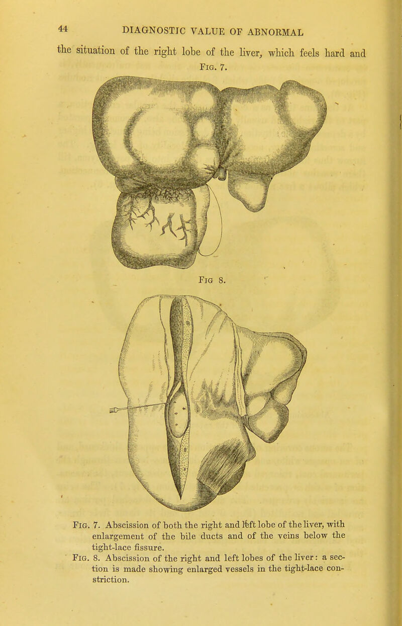 the situation of tlie riglit lobe of the liver, which feels hard and Fig. 7. Fig. 7. Abscission of both the right and Ifeft lobe of the liver, with enlargement of the bile ducts and of the veins below the tight-lace fissure. Fig. 8. Abscission of the right and left lobes of the liver: a sec- tion is made showing enlarged vessels in the tight-lace con- striction.