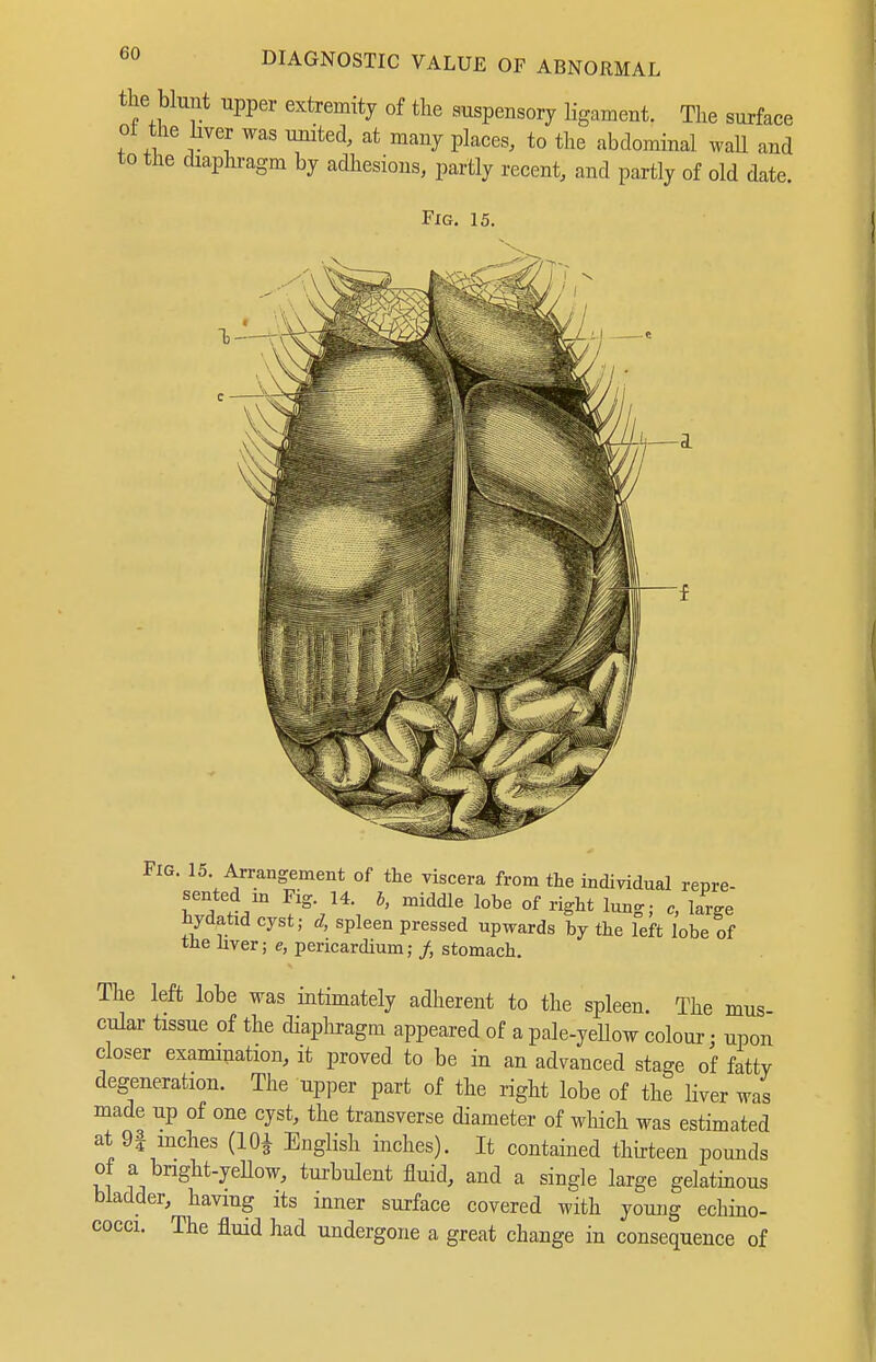 the blunt upper extremity of the suspensory Hgament. The surface ot tHe hver was united, at many places, to the abdominal wall and to the diaphragm by adhesions, partly recent, and partly of old date. FxG. 15. Fig. 15 Arrangement of the viscera from the individual repre- sented in Fig. 14. h, middle lobe of right lung; c, large hydatid cyst; d, spleen pressed upwards by the left lobe of the liver; e, pericardium; /, stomach. The left lobe was intimately adherent to the spleen. The mus cular tissue of the diaphragm appeared of a pale-yeUow colour; upon closer examination, it proved to be in an advanced stage of fatty degeneration. The upper part of the right lobe of the liver was made up of one cyst, the transverse diameter of which was estimated at 9| inches (10^ English inches). It contained thirteen pounds of a bnght-yeUow, turbulent fluid, and a single large gelatinous bladder, having its inner surface covered with young echino- cocci. The fluid had undergone a great change in consequence of