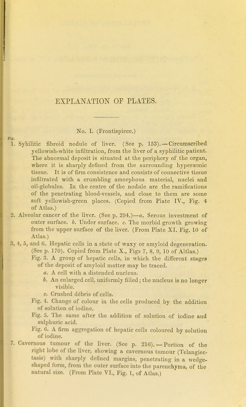 EXPLANATION OF PLATES. No. I. (Frontispiece.) 1. Syhilitic fibroid nodule of liver. (See p. 153). — Circumscribed yellowish-white infiltration, from the liver of a syphilitic patient. The abnormal deposit is situated at the periphery of the organ, where it is sharply defined from the surrounding hyperaemic tissue. It is of firm consistence and consists of connective tissue infiltrated with a crumbling amorphous material, nuclei and oil-globules. In the centre of the nodule are the ramifications of the penetrating blood-vessels, and close to them are some soft yellowish-green places. (Copied from Plate IV., Fig. 4 of Atlas.) 2. Alveolar cancer of the liver. (See p. 294.)—a. Serous investment of outer surface, b. Under surface, c. The morbid growth growing from the upper surface of the liver. (From Plate XI. Fig. 10 of Atlas.) 3. 4, 5, and 6. Hepatic cells in a state of waxy or amyloid degeneration. (See p. 170). Copied from Plate X., Figs 7, 8, 9, 10 of Altlas.) Fig. 3. A group of hepatic cells, in which the different stages of the deposit of amyloid matter may be traced. a. A cell with a distended nucleus. b. An enlarged cell, uniformly filled; the nucleus is no longer visible. c. Crushed debris of cells. Fig. 4. Change of colour in the cells produced by the addition of solution of iodine. Fig. 5. The same after the addition of solution of iodine and sulphuric acid. Fig. G. A firm aggregation of hepatic cells coloured by solution of iodine. 7. Cavernous tumour of the liver. (See p. 21G). — Portion of the right lobe of the liver, showing a cavernous tumour (Telangiec- tasis) with sharply defined margins, penetrating in a wedge- shaped form, from the outer surface into the parenchyma, of the