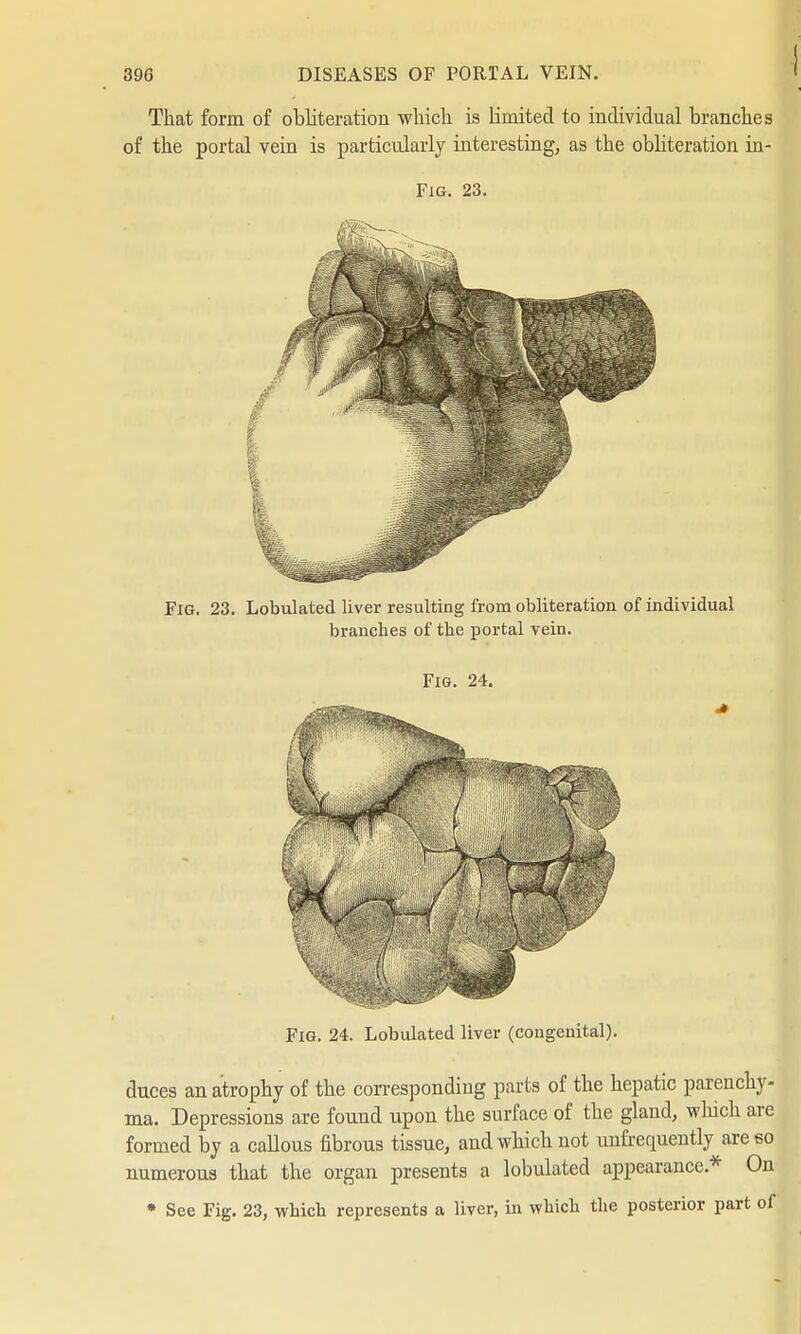 That form of obliteration which is limited to individual branches of the portal vein is particularly interesting, as the obliteration in- Fig. 23. Fig. 23. Lobulated liver resulting from obliteration of individual branches of the portal vein. Fig. 24. Fig. 24. Lobulated liver (congenital). duces an atrophy of the corresponding parts of the hepatic parenchy- ma. Depressions are found upon the surface of the gland, which are formed by a callous fibrous tissue, and which not unfrequently are so numerous that the organ presents a lobulated appearance* On * See Fig. 23, which represents a liver, in which the posterior part of