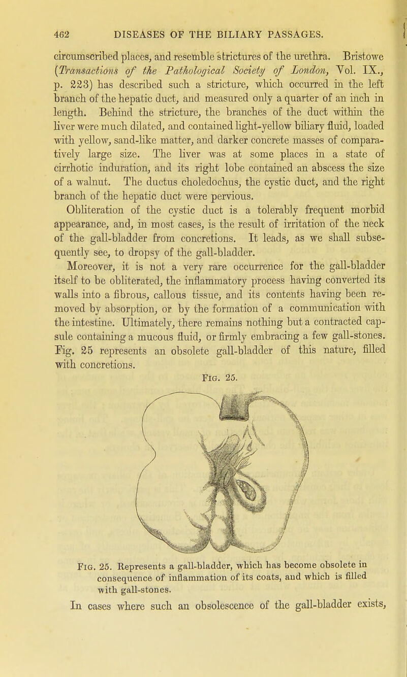 circumscribed places, and resemble strictures of the urethra. Bristowe (Transactions of the Pathological Society of London, Yol. IX., p. 223) has described such a stricture, which occurred in the left branch of the hepatic duct, and measured only a quarter of an inch in length. Behind the stricture, the branches of the duct within the liver were much dilated, and contained light-yellow biliary fluid, loaded with yeUow, sand-like matter, and darker concrete masses of compara- tively large size. The liver was at some places in a state of cirrhotic induration, and its right lobe contained an abscess the size of a walnut. Tbe ductus choledochus, the cystic duct, and the right branch of the hepatic duct were pervious. Obliteration of the cystic duct is a tolerably frequent morbid appearance, and, in most cases, is the result of irritation of the neck of the gall-bladder from concretions. It leads, as we shall subse- quently see, to dropsy of the gall-bladder. Moreover, it is not a very rare occurrence for the gall-bladder itself to be obliterated, the inflammatory process having converted its walls into a fibrous, callous tissue, and its contents having been re- moved by absorption, or by the formation of a communication with the intestine. Ultimately, there remains nothing but a contracted cap- sule containing a mucous fluid, or firmly embracing a few gall-stones. Pig. 25 represents an obsolete gall-bladder of this nature, filled with concretions. Fig. 25. Fig. 25. Represents a gall-bladder, which has become obsolete in consequence of inflammation of its coats, and which is filled with gall-stones. In cases where such an obsolescence of the gall-bladder exists,