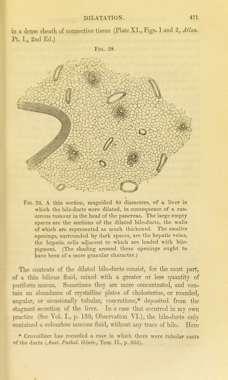 in a dense sheath of connective tissue (Plate XL, Pigs. 1 and 2, Atlas. Pt. L, 2nd Ed.) Fig. 28. Fig. 28. A thin section, magnified 80 diameters, of a liver in which the bile-ducts were dilated, in consequence of a can- cerous tumour in the head of the pancreas. The large empty- spaces are the sections of the dilated bile-ducts, the walls of which are represented as much thickened. The smaller openings, surrounded by dark spaces, are the hepatic veins, the hepatic cells adjacent to which are loaded with bile- pigment. (The shading around these openings ought to have been of a more granular character.) The contents of the dilated bile-ducts consist, for the most part, of a thin bilious fluid, mixed with a greater or less quantity of puriform mucus. Sometimes they are more concentrated, and con- tain an abundance of crystalline plates of Cholesterine, or rounded, angular, or occasionally tubular, concretions,* deposited from the stagnant secretion of the liver. In a case that occurred in my own practice (See Vol. I., p. 139, Observation VI.), the bile-ducts only contained a colourless mucous fluid, without any trace of bile. Here • Cruveilhicr has recorded a case in which there were tubular casts of the ducts {Anal. Pathol. Gendr., Tom. IL, p. 835).