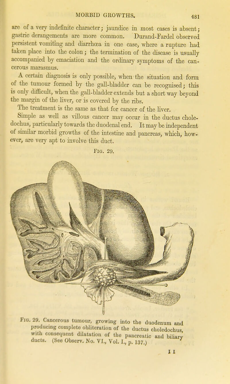 are of a very indefinite character; jaundice in most cases is absent; gastric derangements are more common. Durand-Fardel observed persistent vomiting and diarrhoea in one case, where a rupture had taken place into the colon; the termination of the disease is usually accompanied by emaciation and the ordinary symptoms of the can- cerous marasmus. A certain diagnosis is only possible, when the situation and form of the tumour formed by the gall-bladder can be recognised; this is only difficult, when the gall-bladder extends but a short way beyond the margin of the liver, or is covered by the ribs. The treatment is the same as that for cancer of the liver. Simple as well as villous cancer may occur in the ductus chole- dochus, particularly towards the duodenal end. It may be independent of similar morbid growths of the intestine and pancreas, which, how- ever, are very apt to involve this duct. Fig. 29. Fig. 29. Cancerous tumour, growing into the duodenum and producing complete obliteration of the ductus choledochus with consequent dUatation of the pancreatic and biliary ducts. (See Observ. No. VI., Vol. I., p. 137.) I I