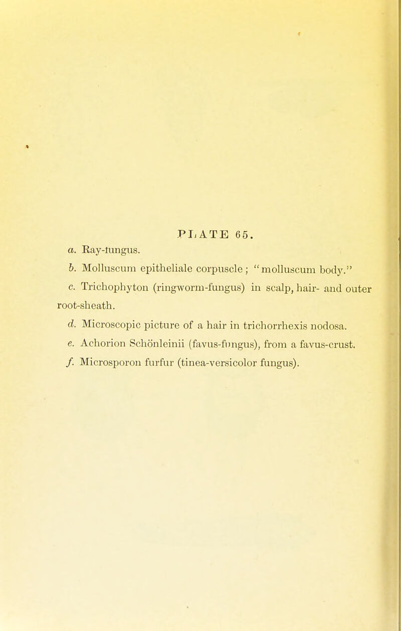 a. Ray-fungus. b. Molluscum epitheliale corpuscle ; molluscum body. c. Trichophyton (ringworm-fungus) in scalp, hair- and outer root-sheath. d. Microscopic picture of a hair in trichorrhexis nodosa. e. Achorion Schönleinii (favus-fnngus), from a favus-crust. /. Microsporon furfur (tinea-versicolor fungus).