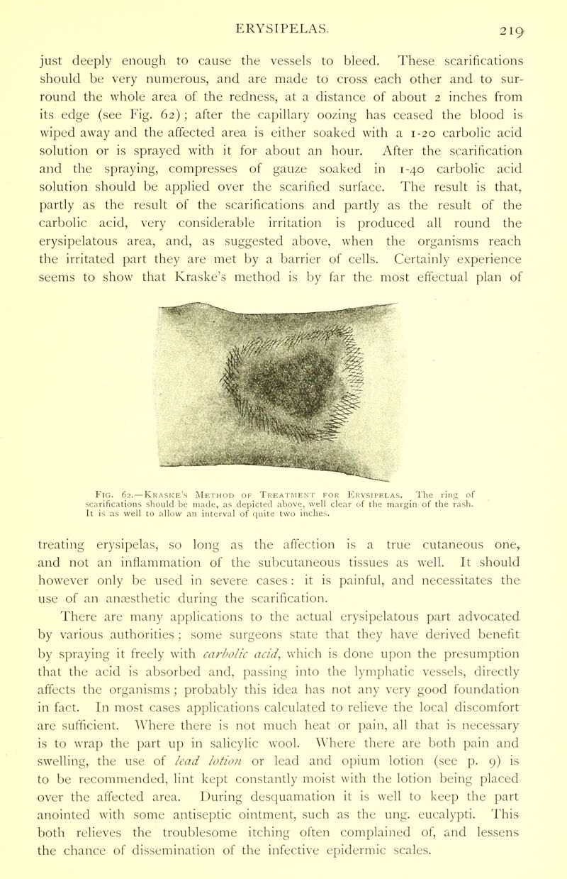 just deeply enough to cause the vessels to bleed. These scarifications should be very numerous, and are made to cross each other and to sur- round the whole area of the redness, at a distance of about 2 inches from its edge (see Fig. 62); after the capillary oozing has ceased the blood is wiped away and the affected area is either soaked with a 1-20 carbolic acid solution or is sprayed with it for about an hour. After the scarification and the spraying, compresses of gauze soaked in 1-40 carbolic acid solution should be applied over the scarified surface. The result is that, partly as the result of the scarifications and partly as the result of the carbolic acid, very considerable irritation is produced all round the erysipelatous area, and, as suggested above, when the organisms reach the irritated part they are met by a barrier of cells. Certainly experience seems to show that Kraske's method is by far the most effectual plan of Fig. 62.—Kraske's Method of Treatment for Erysipelas. The ring of scarifications should be made, as depicted above, well clear of the margin of the rash. It is as well to allow an interval of quite two inches. treating erysipelas, so long as the affection is a true cutaneous one, and not an inflammation of the subcutaneous tissues as well. It should however only be used in severe cases: it is painful, and necessitates the use of an anaesthetic during the scarification. There are many applications to the actual erysipelatous part advocated by various authorities ; some surgeons state that they have derived benefit by spraying it freely with carbolic acid, which is done upon the presumption that the acid is absorbed and, passing into the lymphatic vessels, directly affects the organisms ; probably this idea has not any very good foundation in fact. In most cases applications calculated to relieve the local discomfort are sufficient. Where there is not much heat or pain, all that is necessary is to wrap the part up in salicylic wool. Where there are both pain and swelling, the use of lead lotion or lead and opium lotion (see p. 9) is to be recommended, lint kept constantly moist with the lotion being placed over the affected area. During desquamation it is well to keep the part anointed with some antiseptic ointment, such as the ung. eucalypti. This both relieves the troublesome itching often complained of, and lessens the chance of dissemination of the infective epidermic scales.