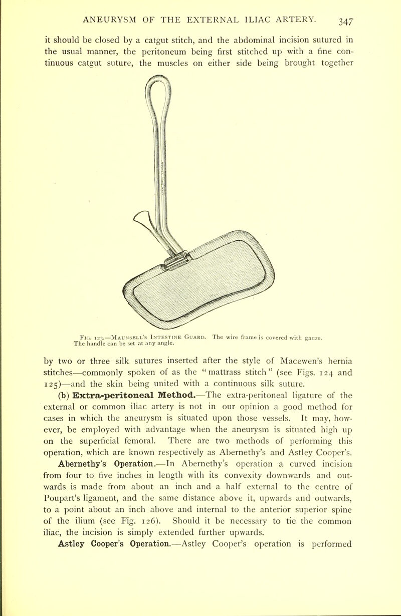 it should be closed by a catgut stitch, and the abdominal incision sutured in the usual manner, the peritoneum being first stitched up with a fine con- tinuous catgut suture, the muscles on either side being brought together Fig. 123.—Maunsell's Intestine Guard. The wire frame is covered with gauze. The handle can he set at any angle. by two or three silk sutures inserted after the style of Macewen's hernia stitches—commonly spoken of as the  mattrass stitch (see Figs. 124 and 125)—and the skin being united with a continuous silk suture. (b) Extra-peritoneal Method.—The extra-peritoneal ligature of the external or common iliac artery is not in our opinion a good method for cases in which the aneurysm is situated upon those vessels. It may, how- ever, be employed with advantage when the aneurysm is situated high up on the superficial femoral. There are two methods of performing this operation, which are known respectively as Abernethy's and Astley Cooper's. Abernethy's Operation.—In Abernethy's operation a curved incision from four to five inches in length with its convexity downwards and out- wards is made from about an inch and a half external to the centre of Poupart's ligament, and the same distance above it, upwards and outwards, to a point about an inch above and internal to the anterior superior spine of the ilium (see Fig. 126). Should it be necessary to tie the common iliac, the incision is simply extended further upwards. Astley Cooper's Operation.—Astley Cooper's operation is performed