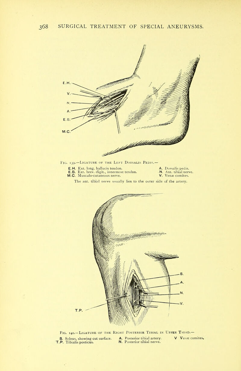 Fig. 139.—Ligature of the Left Dorsalis Pedis.— E.H. Ext. long, hallucis tendon. A. Dorsalis pedis. E.B. Ext. brev. digit., innermost tendon. N. Ant. tibial nerve. M.C. Musculocutaneous nerve. V. Venae comites. The ant. tibial nerve usually lies to the outer side of the artery.