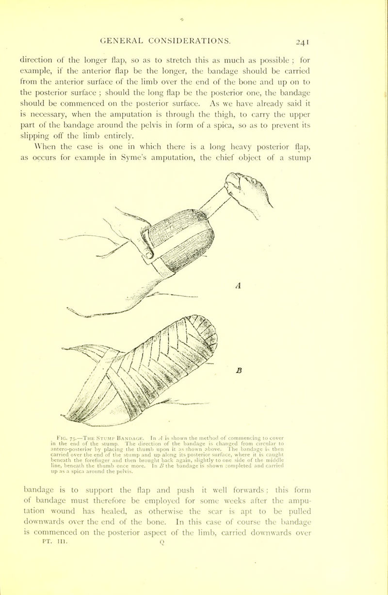 direction of the longer flap, so as to stretch this as much as possible ; for example, if the anterior flap be the longer, the bandage should be carried from the anterior surface of the limb over the end of the bone and up on to the posterior surface ; should the long flap be the posterior one, the bandage should be commenced on the posterior surface. As we have already said it is necessary, when the amputation is through the thigh, to carry the upper part of the bandage around the pelvis in form of a spica, so as to prevent its slipping off the limb entirely. When the case is one in which there is a long heavy posterior flap, as occurs for example in Syme's amputation, the chief object of a stump Fig. 75.—The Stump Bandage. In A is shown the method of commencing 10 cover in the end of the stump. The direction of the bandage is changed from circular to antero-posterior by placing the thumb upon it as shown above. The bandage is then carried over the end of the stump and up along its posterior surface, where it is caught beneath the forefinger and then brought back again, slightly to otic side of the middle line, beneath the thumb once more. In B the bandage is shown completed and carried up as a spica around the pelvis. bandage is to support the flap and push it well forwards : this form of bandage must therefore be employed for some weeks after the ampu- tation wound has healed, as otherwise the scar is apt to be pulled downwards over the end of the bone. In this case of course the bandage is commenced on the posterior aspect of the limb, carried downwards over pt. in. Q