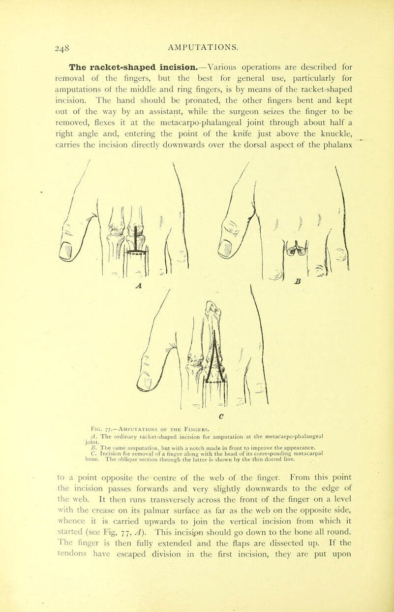 The racket-shaped incision.—Various operations are described for removal of the fingers, but the best for general use, particularly for amputations of the middle and ring fingers, is by means of the racket-shaped incision. The hand should be pronated, the other fingers bent and kept out of the way by an assistant, while the surgeon seizes the finger to be removed, flexes it at the metacarpophalangeal joint through about half a right angle and, entering the point of the knife just above the knuckle, carries the incision directly downwards over the dorsal aspect of the phalanx Fig. 77.—Amputations of the Fingers. A. The ordinary racket-shaped incision for amputation at the metacarpophalangeal joint. B. The same amputation, but with a notch made in front to improve the appearance. C. Incision for removal of a finger along with the head of its corresponding metacarpal bone. The oblique section through the latter is shown by the thin dotted line. to a point opposite the centre of the web of the finger. From this point the incision passes forwards and very slightly downwards to the edge of the web. It then runs transversely across the front of the finger on a level with the crease on its palmar surface as far as the web on the opposite side, whence it is carried upwards to join the vertical incision from which it started (see Fig. 77, A). This incisjpn should go down to the bone all round. The finger is then fully extended and the flaps are dissected up. If the tendons have escaped division in the first incision, they are put upon