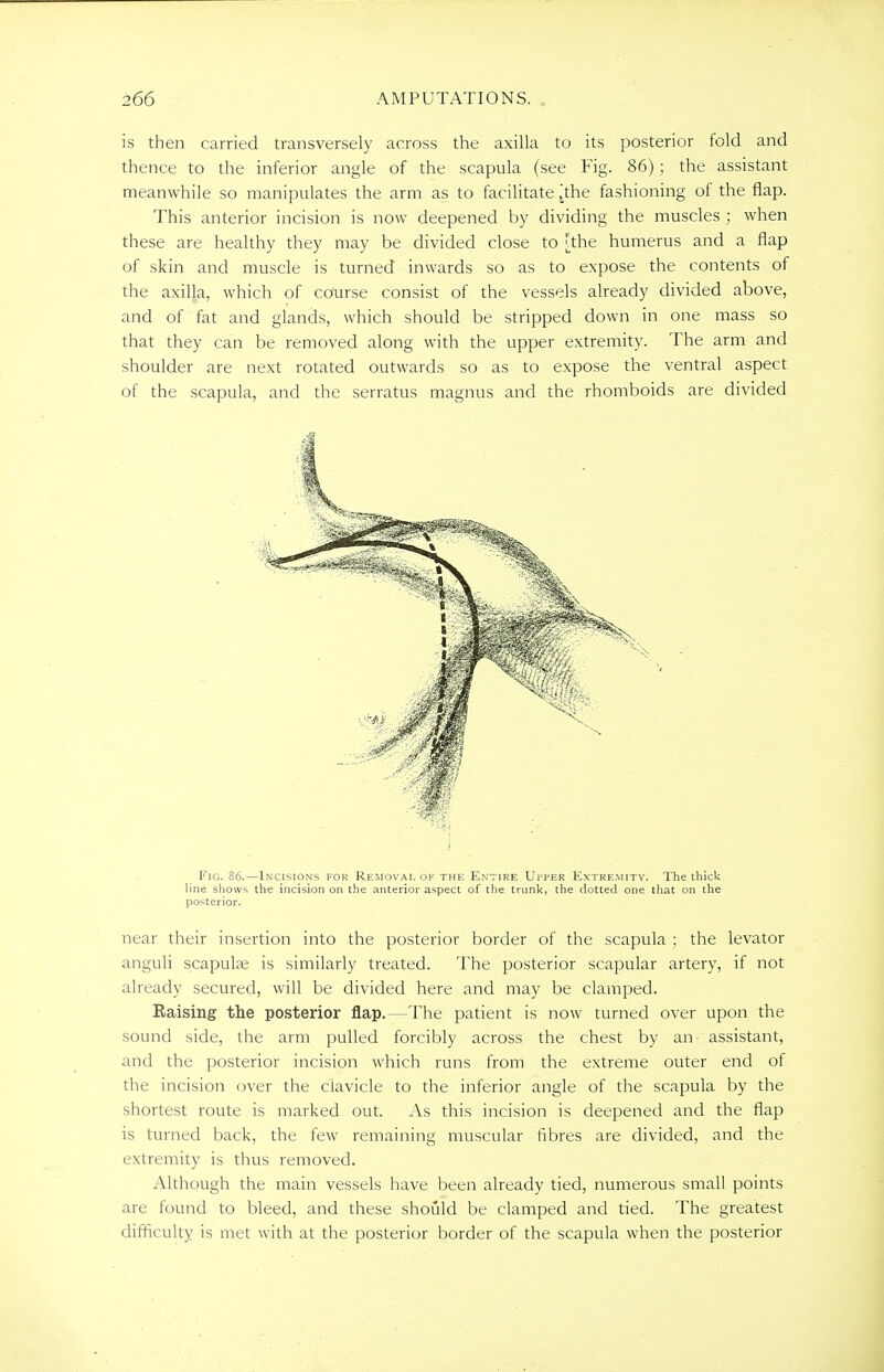 is then carried transversely across the axilla to its posterior fold and thence to the inferior angle of the scapula (see Fig. 86) ; the assistant meanwhile so manipulates the arm as to facilitate [the fashioning of the flap. This anterior incision is now deepened by dividing the muscles ; when these are healthy they may be divided close to [the humerus and a flap of skin and muscle is turned inwards so as to expose the contents of the axilla, which of course consist of the vessels already divided above, and of fat and glands, which should be stripped down in one mass so that they can be removed along with the upper extremity. The arm and shoulder are next rotated outwards so as to expose the ventral aspect of the scapula, and the serratus magnus and the rhomboids are divided Fig. 86.—Incisions for Removal of the Entire Ui'^er Extremity. The thick line shows the incision on the anterior aspect of the trunk, the dotted one that on the posterior. near their insertion into the posterior border of the scapula ; the levator anguli scapula; is similarly treated. The posterior scapular artery, if not already secured, will be divided here and may be clamped. Raising the posterior flap.—The patient is now turned over upon the sound side, the arm pulled forcibly across the chest by an- assistant, and the posterior incision which runs from the extreme outer end of the incision over the clavicle to the inferior angle of the scapula by the shortest route is marked out. As this incision is deepened and the flap is turned back, the few remaining muscular fibres are divided, and the extremity is thus removed. Although the main vessels have been already tied, numerous small points are found to bleed, and these should be clamped and tied. The greatest difficulty is met with at the posterior border of the scapula when the posterior