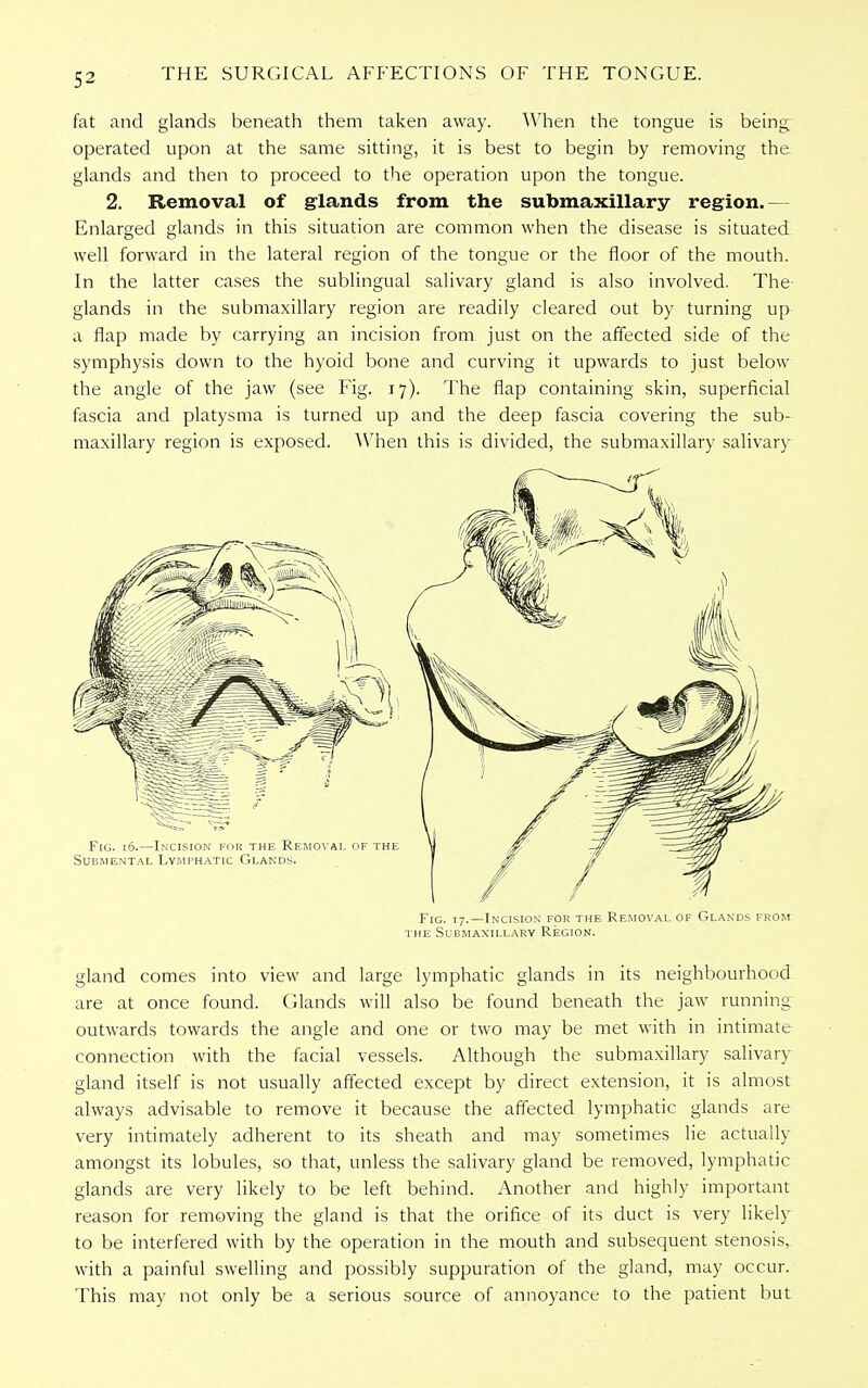 fat and glands beneath them taken away. When the tongue is being operated upon at the same sitting, it is best to begin by removing the glands and then to proceed to the operation upon the tongue. 2. Removal of glands from the submaxillary region.- Enlarged glands in this situation are common when the disease is situated well forward in the lateral region of the tongue or the floor of the mouth. In the latter cases the sublingual salivary gland is also involved. The- glands in the submaxillary region are readily cleared out by turning up a flap made by carrying an incision from just on the affected side of the symphysis down to the hyoid bone and curving it upwards to just below the angle of the jaw (see Fig. 17). The flap containing skin, superficial fascia and platysma is turned up and the deep fascia covering the sub- maxillary region is exposed. AVhen this is divided, the submaxillary salivary Fig. 17.—Incision for the Removal of Glands from the Submaxillary Region. gland comes into view and large lymphatic glands in its neighbourhood are at once found. Glands will also be found beneath the jaw running outwards towards the angle and one or two may be met with in intimate connection with the facial vessels. Although the submaxillary salivary gland itself is not usually affected except by direct extension, it is almost always advisable to remove it because the affected lymphatic glands are very intimately adherent to its sheath and may sometimes lie actually amongst its lobules, so that, unless the salivary gland be removed, lymphatic glands are very likely to be left behind. Another and highly important reason for removing the gland is that the orifice of its duct is very likely to be interfered with by the operation in the mouth and subsequent stenosis, with a painful swelling and possibly suppuration of the gland, may occur. This may not only be a serious source of annoyance to the patient but