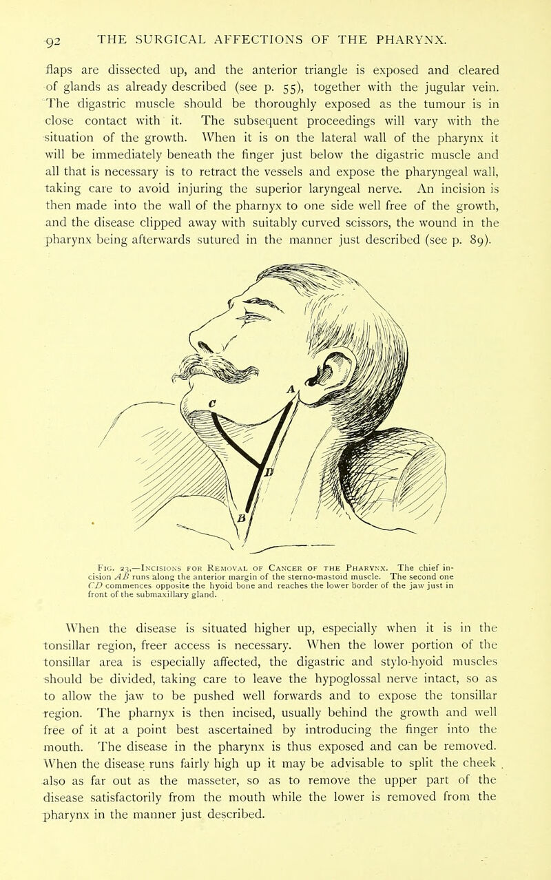 flaps are dissected up, and the anterior triangle is exposed and cleared of glands as already described (see p. 55), together with the jugular vein. 'The digastric muscle should be thoroughly exposed as the tumour is in close contact with it. The subsequent proceedings will vary with the situation of the growth. When it is on the lateral wall of the pharynx it will be immediately beneath the finger just below the digastric muscle and all that is necessary is to retract the vessels and expose the pharyngeal wall, taking care to avoid injuring the superior laryngeal nerve. An incision is then made into the wall of the pharnyx to one side well free of the growth, and the disease clipped away with suitably curved scissors, the wound in the pharynx being afterwards sutured in the manner just described (see p. 89). Fig. 23,—Incisions for Removal of Cancer of the Pharynx. The chief in- cision AB runs along the anterior margin of the sterno-mastoid muscle. The second one CD commences opposite the hyoid bone and reaches the lower border of the jaw just in front of the submaxillary gland. When the disease is situated higher up, especially when it is in the tonsillar region, freer access is necessary. When the lower portion of the tonsillar area is especially affected, the digastric and stylo-hyoid muscles should be divided, taking care to leave the hypoglossal nerve intact, so as to allow the jaw to be pushed well forwards and to expose the tonsillar region. The pharnyx is then incised, usually behind the growth and well free of it at a point best ascertained by introducing the finger into the mouth. The disease in the pharynx is thus exposed and can be removed. When the disease runs fairly high up it may be advisable to split the cheek also as far out as the masseter, so as to remove the upper part of the disease satisfactorily from the mouth while the lower is removed from the pharynx in the manner just described.