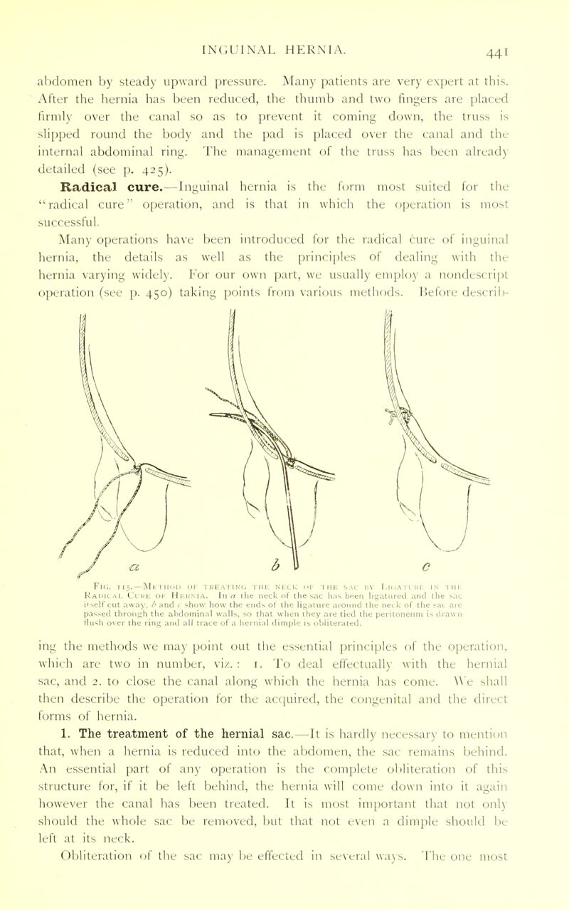 abdomen by steady upward pressure. Many patients are very expert at this. After the hernia has been reduced, the thumb and two fingers are placed firmly over the canal so as to prevent it coming down, the truss is slipped round the body and the pad is placed over the canal and the internal abdominal ring. The management of the truss has been ahead) detailed (see p. 425). Radical cure.—Inguinal hernia is the form most suited for the radical cure operation, and is that in which the operation is most successful. Many operations have been introduced for the radical cure of inguinal hernia, the details as well as the principles of dealing with the hernia varying widely. For our own part, we usually employ a nondescript operation (see p. 450) taking points from various methods, before describ- ing the methods we may point out the essential principles of the operation, which are two in number, viz. : 1. To deal effectually with the hernial sac, and 2. to close the canal along which the hernia has come. We shall then describe the operation for the acquired, the congenital and the direct forms of hernia. 1. The treatment of the hernial sac.—It is hardly necessary to mention that, when a hernia is reduced into the abdomen, the sac remains behind. An essential part of any operation is the complete obliteration of this structure for, if it be left behind, the hernia will come down into it again however the canal has been treated. It is most important that not only should the whole sac be removed, but that not even a dimple should be left at its neck. Obliteration of the sac may be effected in several ways. The one most Fig. 115.—Method of treating the neck of the sac by Ligature in thh Radical Cure OF Hkkma. In a the neck of the sac has been ligatured and the sac it.self cut away, /' and c show how the ends of the ligature around the neck of the sat are passed through the abdominal walls, so that when they are lied the peritoneum is draw n flush over the ring and all trace of a hernial dimple is obliterated.