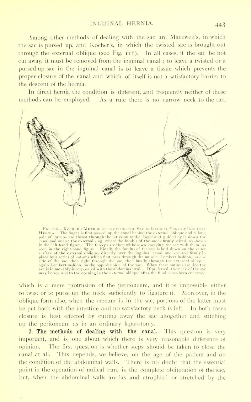 Among other methods of dealing with the sac are Macewen's, in which the sac is pursed up, and Kocher's, in which the twisted sac is brought out through the external oblique (see Fig. n6). In all cases, if the sac be not cut away, it must be removed from the inguinal canal ; to leave a twisted or a pursed-up sac in the inguinal canal is to leave a tissue which prevents the proper closure of the canal and which of itself is not a satisfactory barrier to the descent of the hernia. In direct hernia the condition is different, and frequently neither of these methods can be employed. As a rule there is no narrow neck to the sac, Fig. i i6.—Kocher's Method or i kkatin<; the Sac in Radical Cure of Inguinal Hernia. The finger is first passed up the canal behind the external oblique and a long pair of lorceps are thrust through the latter on to the finger and guided by it down the canal and out at the external ring, where the fundus of the sac is hrmly seized, as shown in the left-hand figure. The forceps are then withdrawn carrying the sac with them, as seen in the right-hand figure. Finally the fundus of the sac is laid down on the outer surface of the external oblique, directly over the inguinal canal, and secured firmly in place by a series of sutures which first pass through the muscle, l.cmbert-fashion, on one side of the sac, then right through the sac, then finally through the external oblique, again Lemhert-fashion. on the opposite side of the sac. When these sutures are tied the sac is immovably incorporated with the abdominal wall. If preferred, the neck of the sac may Ire secured to the opening in the external oblique after the fundus has been cut away. which is a mere protrusion of the peritoneum, and it is impossible either to twist or to purse up the neck sufficiently to ligature it. Moreover, in the oblique form also, when the caecum i.> in the sac, portions of the latter must be put back with the intestine and no satisfactory neck is left. In both cases closure is best effected by cutting away the sac altogether and stitching up the peritoneum as in an ordinary laparotomy. 2. The methods of dealing with the canal. -This question is very important, and is one about which there is very reasonable difference of opinion. The first question is whether steps should be taken to close the canal at all. This depends, we believe, on the age of the patient and on the condition of the abdominal walls. There is no doubt that the essential point in the operation of radical cure is the complete obliteration of the sac, but, when the abdominal walls are lax and atrophied or stretched by the /