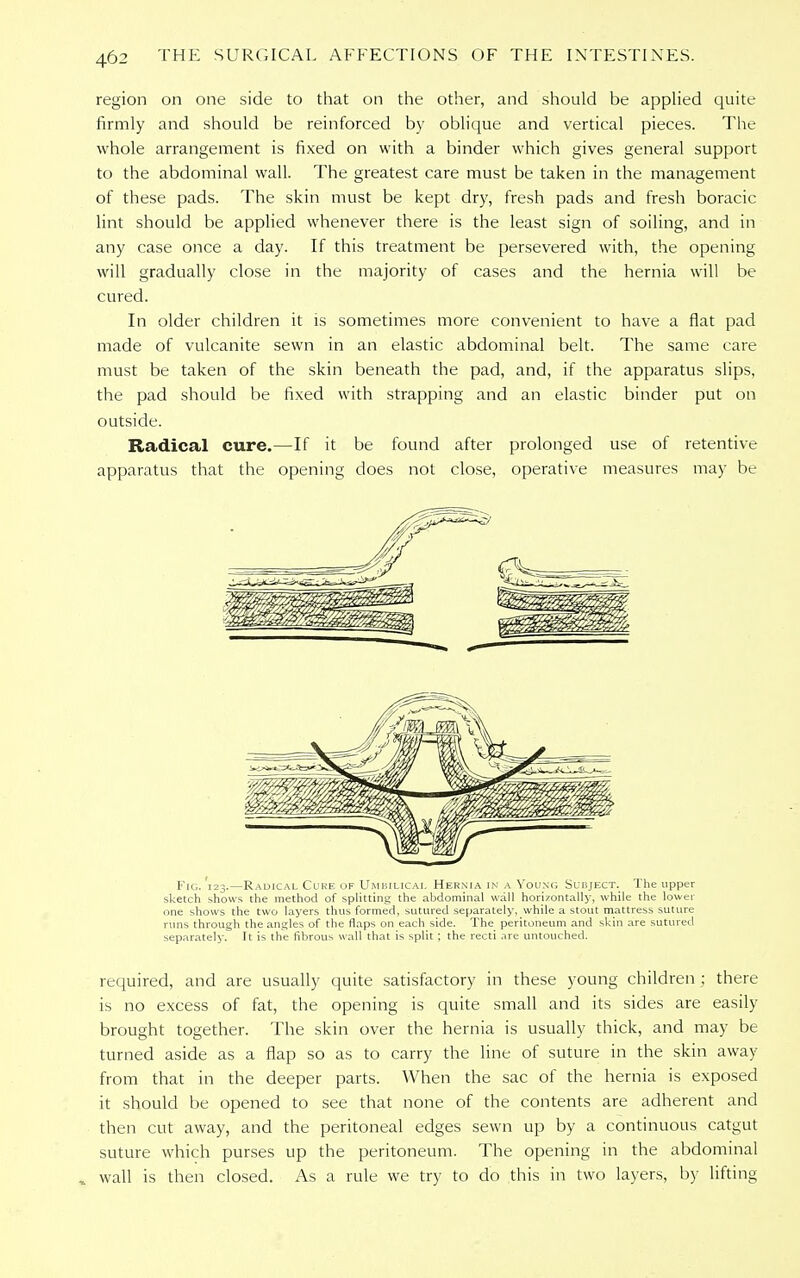 region on one side to that on the other, and should be applied quite firmly and should be reinforced by oblique and vertical pieces. The whole arrangement is fixed on with a binder which gives general support to the abdominal wall. The greatest care must be taken in the management of these pads. The skin must be kept dry, fresh pads and fresh boracic lint should be applied whenever there is the least sign of soiling, and in any case once a day. If this treatment be persevered with, the opening will gradually close in the majority of cases and the hernia will be cured. In older children it is sometimes more convenient to have a flat pad made of vulcanite sewn in an elastic abdominal belt. The same care must be taken of the skin beneath the pad, and, if the apparatus slips, the pad should be fixed with strapping and an elastic binder put on outside. Radical cure.—-If it be found after prolonged use of retentive apparatus that the opening does not close, operative measures may be Fig. 123.—Radical Cure of Umbilical Hernia in a Young Subject. The upper sketch shows the method of splitting the abdominal wall horizontally, while the lower one shows the two layers thus formed, sutured separately, while a stout mattress suture runs through the angles of the flaps on each side. The peritoneum and skin are sutured separately. It is the fibrous wall that is split; the recti are untouched. required, and are usually quite satisfactory in these young children ; there is no excess of fat, the opening is quite small and its sides are easily brought together. The skin over the hernia is usually thick, and may be turned aside as a flap so as to carry the line of suture in the skin away from that in the deeper parts. When the sac of the hernia is exposed it should be opened to see that none of the contents are adherent and then cut away, and the peritoneal edges sewn up by a continuous catgut suture which purses up the peritoneum. The opening in the abdominal * wall is then closed. As a rule we try to do this in two layers, by lifting