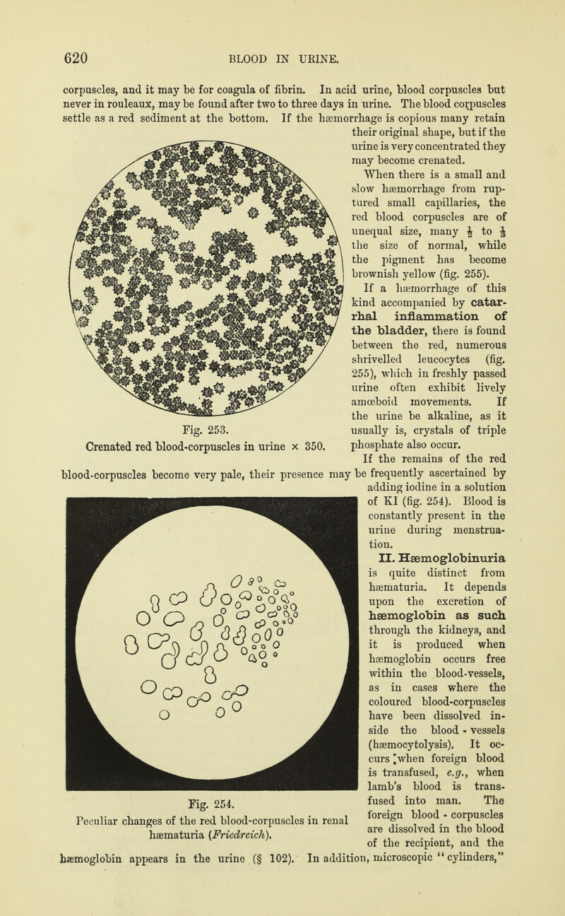 corpuscles, and it may be for coagula of fibrin. In acid urine, blood corpuscles but never in rouleaux, may be found after two to three days in urine. The blood corpuscles settle as a red sediment at the bottom. If the haemorrhage is copious many retain their original shape, but if the urine is very concentrated they may become crenated. When there is a small and slow haemorrhage from rup¬ tured small capillaries, the red blood corpuscles are of unequal size, many ^ to ^ the size of normal, while the pigment has become brownisli yellow (fig. 255). If a haemorrhage of this kind accompanied by catar¬ rhal inflammation of the bladder, there is found between the red, numerous shrivelled leucocytes (fig. 255), which in freshly passed urine often exhibit lively amoeboid movements. If the urine be alkaline, as it usually is, crystals of triple phosphate also occur. If the remains of the red blood-corpuscles become very pale, their presence may be frequently ascertained by adding iodine in a solution of KI (fig. 254). Blood is constantly present in the urine during menstrua¬ tion. II. Heemoglobinuria is quite distinct from hsematuria. It depends upon the excretion of haemoglobin as such through the kidneys, and it is produced when haemoglobin occurs free within the blood-vessels, as in cases where the coloured blood-corpuscles have been dissolved in¬ side the blood - vessels (hsemocytolysis). It oc¬ curs ’when foreign blood is transfused, e.g., when lamb’s blood is trans¬ fused into man. The foreign blood - corpuscles are dissolved in the blood of the recipient, and the haemoglobin appears in the urine (§ 102). In addition, microscopic “ cylinders,” Fig. 254. Peculiar changes of the red blood-corpuscles in renal haematuria (Friedreich). Fig. 253. Crenated red blood-corpuscles in urine x 350.