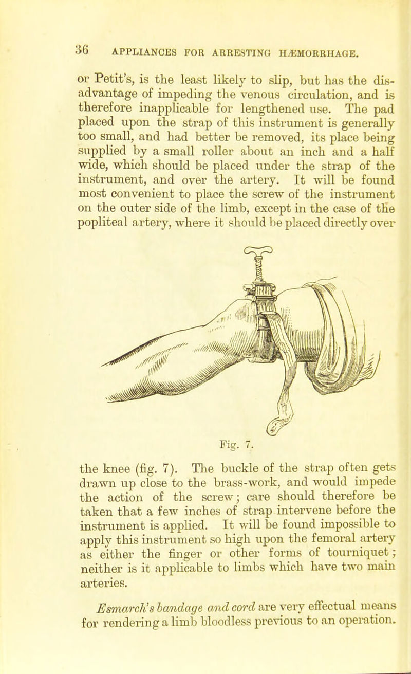 or Petit's, is the least likely to slip, but has the dis- advantage of impeding the venous circulation, and is therefore inapplicable for lengthened use. The pad placed upon the strap of this insti-ument is generally too small, and had better be removed, its place being supplied by a small roller about an inch and a half wide, vi^hich should be placed under the strap of the instrument, and over the artery. It will be found most convenient to place the screw of the instrument on the outer side of the limb, except in the case of the popliteal artery, where it should be placed directly over Fig. 7. the knee (fig. 7). Tlie buckle of the strap often gets drawn up close to the brass-work, and would impede the action of the screw; care should therefore be taken that a few inches of sti-ap intervene before the instrument is applied. It will be found impossible to apply this instrument so high upon the femoral artery as either the finger or other forms of tourniquet; neither is it applicable to limbs which have two main arteries. Esmarch's bandage and cord are very effectual means for rendering a limb bloodless previous to an operation.