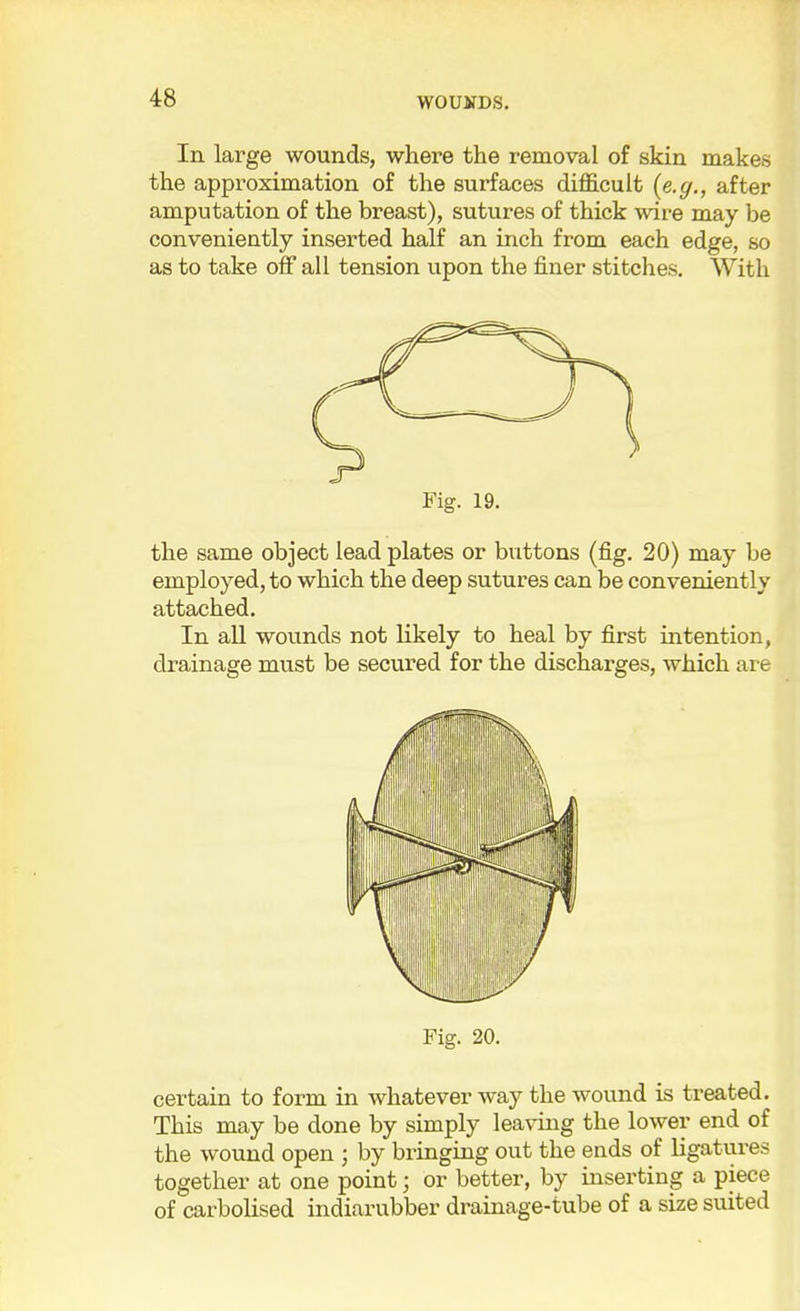 In large wounds, where the removal of skin makes the approximation of the surfaces difficult {e.g., after amputation of the breast), sutures of thick wire may be conveniently inserted half an inch from each edge, so as to take off all tension upon the finer stitches. With Fig. 19. the same object lead plates or buttons (fig. 20) may be employed, to which the deep sutures can be conveniently attached. In all wounds not likely to heal by first intention, drainage must be secured for the discharges, which are Fig. 20. certain to form in whatever way the wound is treated. This may be done by simply leaving the lower end of the wound open ; by bringing out the ends of ligatures together at one point; or better, by inserting a piece of carbolised indiarubber drainage-tube of a size suited