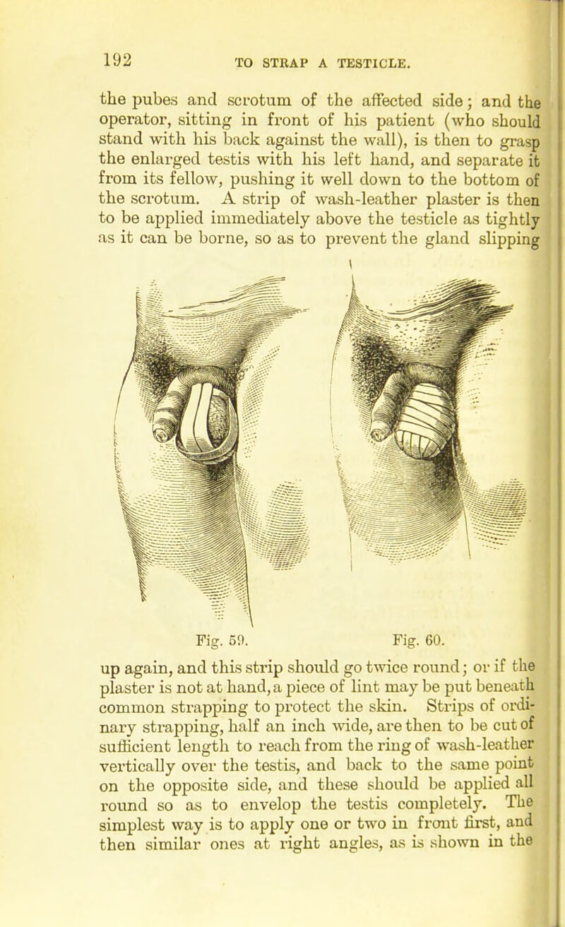 the pubes and scrotum of the affected side; and the operator, sitting in front of his patient (who should stand with his back against the wall), is then to grasp the enlarged testis with his left hand, and separate it from its fellow, pushing it well down to the bottom of the scrotum. A strip of wash-leather plaster is then to be applied immediately above the testicle as tightly as it can be borne, so as to prevent the gland slipping Fig. 59. Fig. 60. up again, and this strip should go twice round; or if the plaster is not at hand, a piece of lint may be put beneath common strapping to protect the skin. Strips of ordi- nary strapping, half an inch wide, are then to be cut of sufficient length to reach from the ring of wash-leather vertically over the testis, and back to the same point on the opposite side, and these should be applied all round so as to envelop the testis completely. The simplest way is to apply one or two in front first, and then similar ones at right angles, as is shown in the