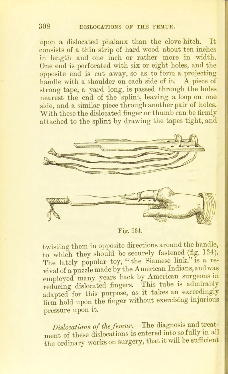 upon a dislocated phalanx than the clove-hitch. It consists of a thin strip of hard wood about ten inches in length and one inch or rather more in width. One end is perforated with six or eight holes, and the opposite end is cut away, so as to form a projecting handle with a shoulder on each side of it. A piece of strong tape, a yard long, is passed through the holes nearest the end of the splint, leaving a loop on one side, and a similar piece through another pair of holes. With these the dislocated finger or thumb can be firmly attached to the splint by drawing the tapes tight, and Fig. 134. twisting them in opposite directions around the handle, to which they should be securely fastened (fig. 134). The lately popular toy,  the Siamese link, is a re- vival of a puzzle made by the American Indians, and Avas employed many vears back by American surgeons in reducing dislocated fingers. This tube is admirably adapted for this purpose, as it takes an exceedingly firm hold upon the finger Avithout exercising injurious pressure upon it. Dislocations of the femzir.—The diagnosis and treat- ment of these dislocations is entered into so fully in all the ordinary works on surgery, that it wiU be sufficient