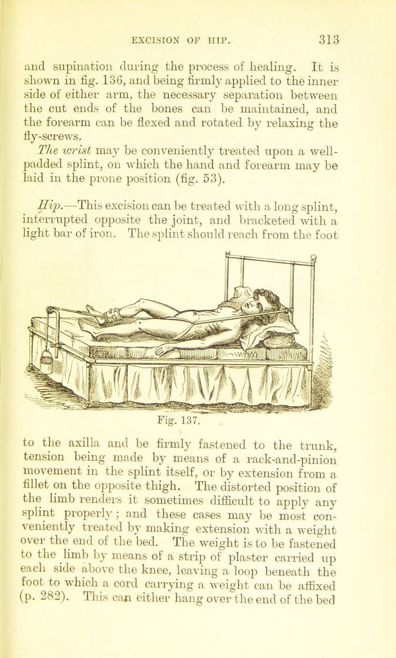 and supination during the process of healing. It is shown in fig. 136, and being firmly applied to the inner side of either arm, the necessary separtition between the cut ends of the bones can be maintained, and the forearm can be flexed and rotated by relaxing the fly-screws. The lorist may be conveniently treated upon a well- padded splint, on which the hand and foiearm may be laid in the prone position (fig. 53). Ilij}.—This excision can be treated with a long splint, interrupted opposite the joint, and bracketed with a light bar of iron. The splint should reach from the foot Fig. 137. to the axilla and be firmly fastened to the trunk, tension being made by means of a rack-and-pinion movement in the splint itself, or by extension from a fillet on the opposite thigh. The distorted position of the limb renders it sometimes difiicult to apply any splint properly ; and these cases may be most con- veniently treated by making extension with a wei2:ht over the end of the bed. The weight is to be fastened to the limb by means of a strip of plaster carried up each side above the knee, leaving a loop beneath the foot to which a cord carrying a weight can be aflixed (p. 282). This can either hang over the end of the bed