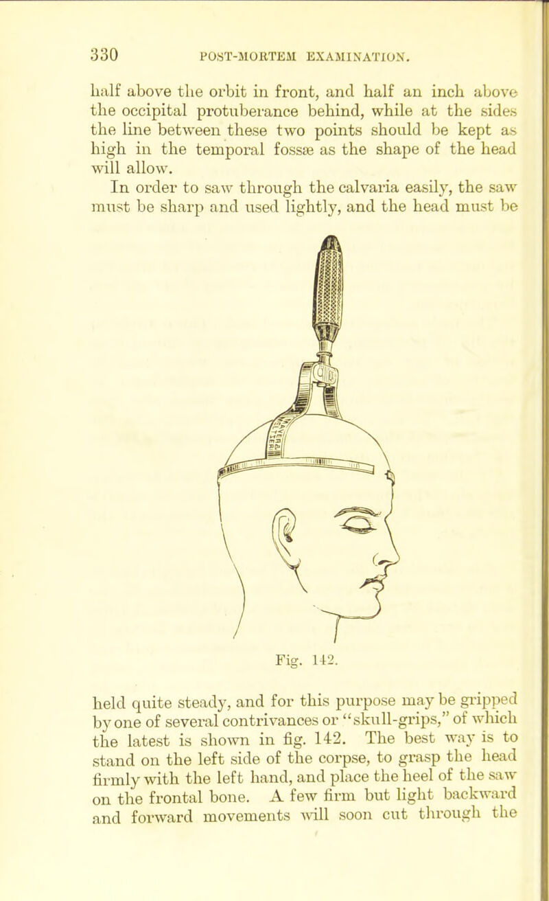 half above the orbit in front, and half an inch above the occipital protubeiunce behind, while at the sides the line between these two points should be kept as high in the temporal fossae as the shape of the head will allow. In order to saw through the calvaria easily, the saw must be sharp and used lightly, and the head must be Fig. 142. held quite steady, and for this purpose may be gripped by one of several contrivances or skull-grips, of which the latest is shown in fig. 142. The best way is to stand on the left side of the corpse, to grasp the head firmly with the left hand, and place the heel of the saw on the frontal bone. A few firm but light backward and forward movements mil soon cut through the
