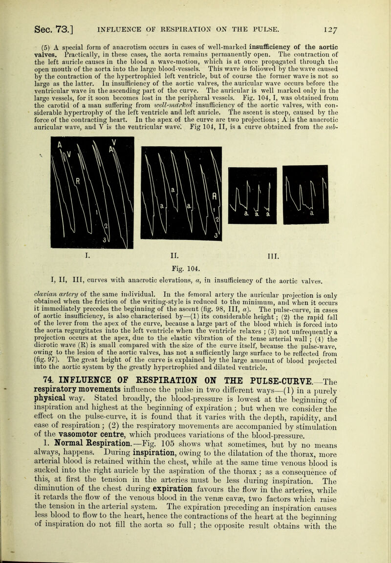 (5) A special form of anacrotism occurs in cases of well-marked insufficiency of the aortic valves. Practically, in these cases, the aorta remains permanently open. The contraction of the left auricle causes in the blood a wave-motion, which is at once propagated through the open mouth of the aorta into the large blood-vessels. This wave is followed by the wave caused by the contraction of the hypertrophied left ventricle, but of course the former wave is not so large as the latter. In insufficiency of the aortic valves, the auricular wave occurs before the ventricular wave in the ascending part of the curve. The auricular is well marked only in the large vessels, for it soon becomes lost in the peripheral vessels. Fig. 104, I, was obtained from the carotid of a man suffering from well-marked insufficiency of the aortic valves, with con- siderable hypertrophy of the left ventricle and left auricle. The ascent is steep, caused by the force of the contracting heart. In the apex of the curve are two projections; A is the anacrotic auricular wave, and V is the ventricular wave'. Fig 104, II, is a curve obtained from the siib- I. II. III. Fig. 104. I, II, III, curves with anacrotic elevations, ci, in insufficiency of the aortic valves. elavian artery of the same individual. In the femoral artery the auricular projection is only obtained when the friction of the writing-style is reduced to the minimum, and when it occurs it immediately precedes the beginning of the ascent (fig. 98, III, a). The pulse-curve, in cases of aortic insufficiency, is also characterised by—(1) its considerable height; (2) the rapid fall of the lever from the apex of the curve, because a large part of the blood which is forced into the aorta regurgitates into the left ventricle when the ventricle relaxes ; (3) not unfrequently a projection occurs at the apex, due to the elastic vibration of the tense arterial wall ; (4) the dicrotic wave (K_) is small compared with the size of the curve itself, because the pulse-wave, owing to the lesion of the aortic valves, has not a sufficiently large surface to be reflected from (fig. 97). The great height of the curve is explained by the large amount of blood projected into the aortic system by the greatly hypertrophied and dilated ventricle. 74. INFLUENCE OF RESPIRATION ON THE PULSE-CURVE.—The respiratory movements influence the pulse in two diff'erent ways—(1) in a jDurely physical way. Stated broadly, the blood-pressure is lowest at the beginning of inspiration and highest at the beginning of expiration; but when we consider the effect on the pulse-curve, it is found that it varies with the depth, rapidity, and ease of respiration; (2) the respiratory movements are accompanied by stimulation of the vasomotor centre, which produces variations of the blood-pressure. 1. Normal Respiration.—Fig. 105 shows what sometimes, but by no means always, happens. During inspiration, owing to the dilatation of the thorax, more arterial blood is retained within the chest, while at the same time venous blood is sucked into the right auricle by the aspiration of the thorax; as a consequence of this, at first the tension in the arteries must be less during inspiration. The diminution of the chest during expiration favours the flow in the arteries, while it retards the flow of the venous blood in the venae cavse, two factors which raise the tension in the arterial system. The expiration preceding an inspiration causes less blood to flow to the heart, hence the contractions of the heart at the beginning of inspiration do not All the aorta so full; the opposite result obtains with the
