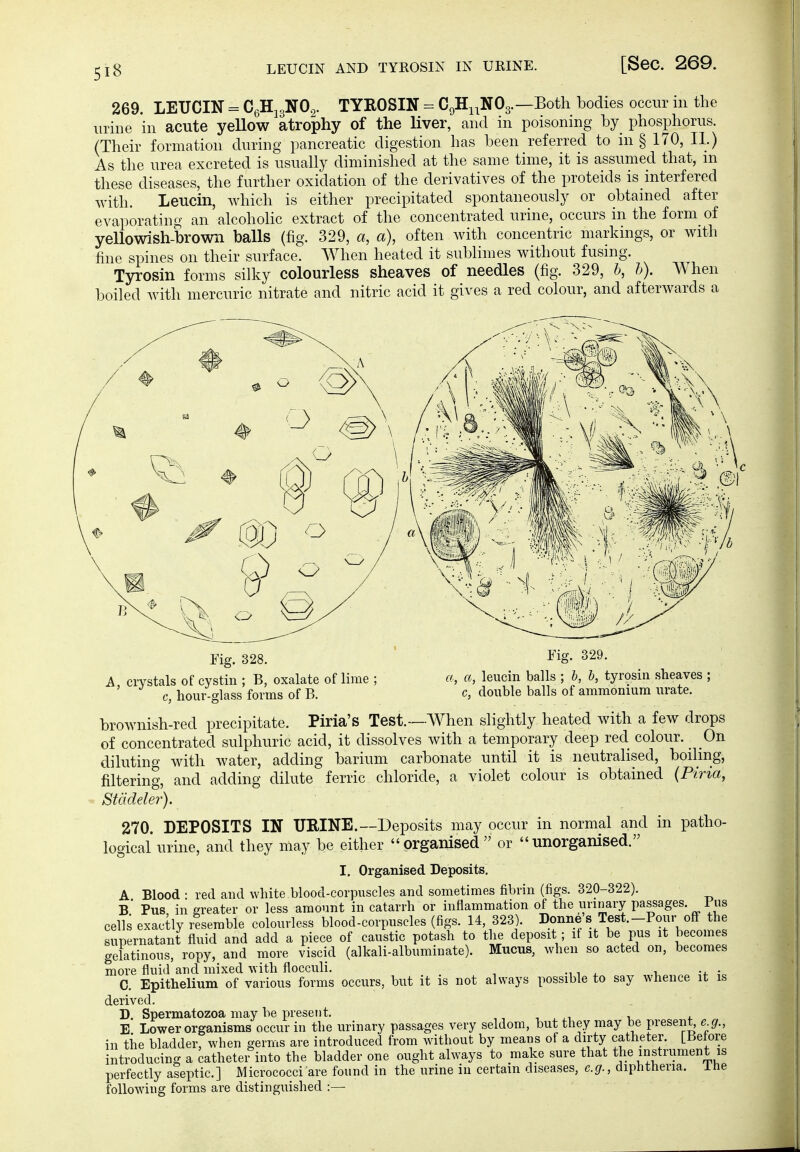 269. LEUCIN = C^'S^.^.'SO^- TYROSIN = CgHi.NOg.—Both bodies occur m the urine in acute yellow atrophy of the liver, and in poisoning by phosphorus. (Their formation during pancreatic digestion has been referred to in § 170, II.) As the urea excreted is usually diminished at the same time, it is assumed that, m these diseases, the further oxidation of the derivatives of the proteids is interfered with. Lencin, which is either precipitated spontaneously or obtained after evaporating an alcoholic extract of the concentrated urine, occurs in the form of yellowish-brown balls (fig. 329, a, a), often with concentric markings, or with fine spines on their surface. When heated it sublimes without fusing. Tyrosin forms silky colourless sheaves of needles (fig. 329, b, h). When boiled Avith mercuric nitrate and nitric acid it gives a red colour, and afterwards a Fig. 328. A, crystals of cystin ; B, oxalate of lime ; c, hour-fflass forms of B. Fig. 329. a, a, leucin balls ; h, b, tyrosin sheaves ; c, double balls of ammonium urate. brownish-red precipitate. Piria's Test.—When slightly heated with a few drops of concentrated sulphuric acid, it dissolves with a temporary deep red colour. On diluting with water, adding barium carbonate until it is neutralised, boding, filtering, and adding dilute ferric chloride, a violet colour is obtained (Piria, Stcideler). 270. DEPOSITS IN UEINE.—Deposits may occur in normal and in patho- logical urine, and they may be either organised or unorganised. I. Organised Beposits. A Blood : red and white blood-corpuscles and sometimes fibrin (figs. 320-322). b' Pus in greater or less amount in catarrh or inflammation of the urinary passages. I ns cells exactly rlsemble colourless blood-corpuscles (figs. 14, 323). Bonne's Test.-Pour off the supernatant fluid and add a piece of caustic potash to the deposit; if it be pus it becomes gelatinous, ropy, and more viscid (alkali-albuminate). Mucus, when so acted on, becomes more fluid and mixed with flocculi. i ^ t, -4. • C. Epithelium of various forms occurs, but it is not always possible to say whence it is derived. B. Spermatozoa may be present. , . ,t i E Lower organisms occur in the urinary passages very seldom, but they may be present, e^g., in the bladder, when germs are introduced from without by means of a dirty catheter. [Before introducing a cathetei into the bladder one ought always to make sure that the instrument is perfectly aseptic] Micrococci are found in the urine in certain diseases, e.g., diphtheria, ihe following forms are distinguished :—