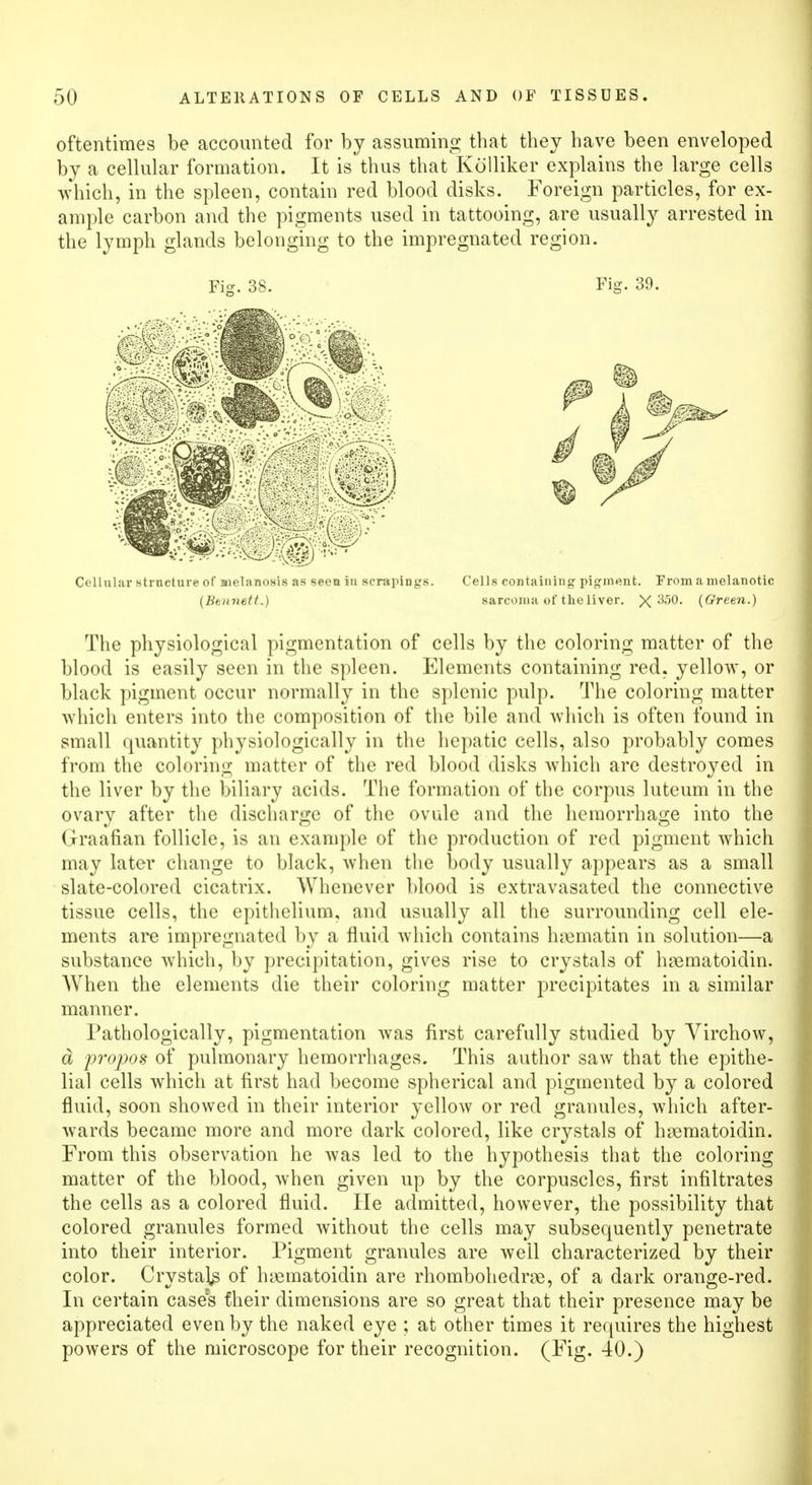 oftentimes be accounted for by assuming that they have been enveloped by a cellular formation. It is thus that Kolliker explains the large cells which, in the spleen, contain red blood disks. Foreign particles, for ex- ample carbon and the pigments used in tattooing, are usually arrested in the lymph glands belonging to the impregnated region. Fig. 38. Fig. 39. Cellular structure of melanosis as seen in scrapiDgs. Cells containing pigment. From a melanotic (Bennett.) sarcoma of the liver. ~X'3i>0. (Green.) The physiological pigmentation of cells by the coloring matter of the blood is easily seen in the spleen. Elements containing red, yellow, or black pigment occur normally in the splenic pulp. The coloring matter which enters into the composition of the bile and which is often found in small quantity physiologically in the hepatic cells, also probably comes from the coloring matter of the red blood disks which are destroyed in the liver by the biliary acids. The formation of the corpus luteum in the ovary after the discharge of the ovule and the hemorrhage into the Graafian follicle, is an example of the production of red pigment which may later change to black, when the body usually appears as a small slate-colored cicatrix. Whenever blood is extravasated the connective tissue cells, the epithelium, and usually all the surrounding cell ele- ments are impregnated by a fluid which contains hrematin in solution—a substance which, by precipitation, gives rise to crystals of haematoidin. When the elements die their coloring matter precipitates in a similar manner. Pathologically, pigmentation was first carefully studied by Virchow, d propos of pulmonary hemorrhages. This author saw that the epithe- lial cells which at first had become spherical and pigmented by a colored fluid, soon showed in their interior yellow or red granules, which after- wards became more and more dark colored, like crystals of hsematoidin. From this observation he was led to the hypothesis that the coloring matter of the blood, when given up by the corpuscles, first infiltrates the cells as a colored fluid. He admitted, however, the possibility that colored granules formed without the cells may subsequently penetrate into their interior. Pigment granules are well characterized by their color. Crystals of h^ematoidin are rhombohedrae, of a dark orange-red. In certain cases their dimensions are so great that their presence may be appreciated even by the naked eye ; at other times it requires the highest powers of the microscope for their recognition. (Fig. 40.)