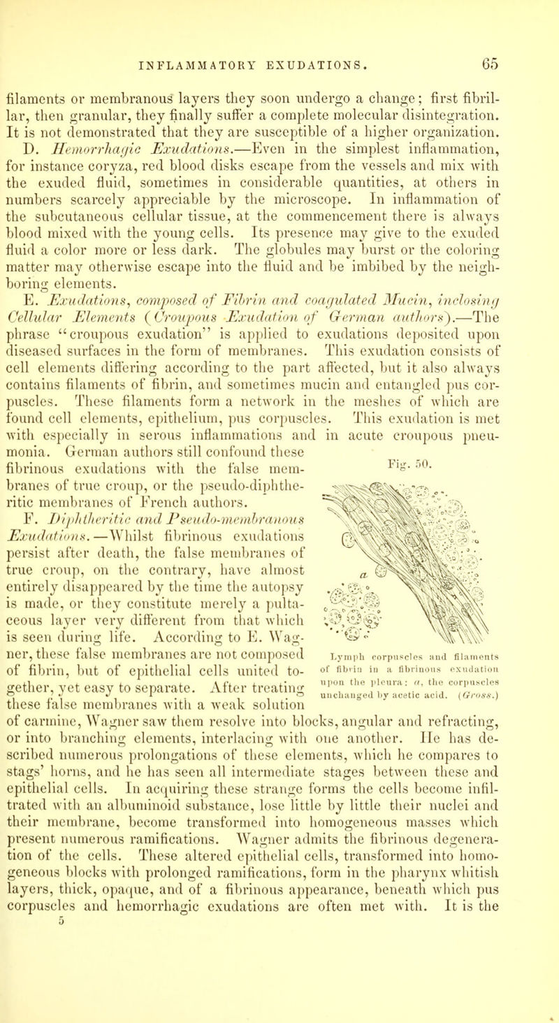 filaments or membranous layers they soon undergo a change; first fibril- lar, then granular, they finally suffer a complete molecular disintegration. It is not demonstrated that they are susceptible of a higher organization. D. Hemorrhagic Exudations.—Even in the simplest inflammation, for instance coryza, red blood disks escape from the vessels and mix with the exuded fluid, sometimes in considerable quantities, at others in numbers scarcely appreciable by the microscope. In inflammation of the subcutaneous cellular tissue, at the commencement there is always blood mixed with the young cells. Its presence may give to the exuded fluid a color more or less dark. The globules may burst or the coloring matter may otherwise escape into the fluid and be imbibed by the neigh- boring elements. E. Exudations, composed of Fibrin and coagulated Mucin, inclosing Cellular Elements {Croupous Exudation of German authors).—The phrase croupous exudation is applied to exudations deposited upon diseased surfaces in the form of membranes. This exudation consists of cell elements differing according to the part affected, but it also always contains filaments of fibrin, and sometimes mucin and entangled pus cor- puscles. These filaments form a network in the meshes of which are found cell elements, epithelium, pus corpuscles. This exudation is met with especially in serous inflammations and in acute croupous pneu- monia. German authors still confound these fibrinous exudations with the false mem- branes of true croup, or the pseudo-diphthe- ritic membranes of French authors. F. Diphtheritic and Pseudo-membranous Exudations.—Whilst fibrinous exudations persist after death, the false membranes of true croup, on the contrary, have almost entirely disappeared by the time the autopsy is made, or they constitute merely a pulta- ceous layer very different from that which is seen during life. According to E. ^Va^•- ner, these false membranes are not composed of fibrin, but of epithelial cells united to- gether, yet easy to separate. After treating these false membranes with a weak solution of carmine, Wagner saw them resolve into blocks, angular and refracting, or into branching elements, interlacing with one another. He has de- scribed numerous prolongations of these elements, which he compares to stags' horns, and he has seen all intermediate stages between these and epithelial cells. In acquiring these strange forms the cells become infil- trated with an albuminoid substance, lose little by little their nuclei and their membrane, become transformed into homogeneous masses which present numerous ramifications. Wagner admits the fibrinous degenera- tion of the cells. These altered epithelial cells, transformed into homo- geneous blocks with prolonged ramifications, form in the pharynx whitish layers, thick, opaque, and of a fibrinous appearance, beneath which pus corpuscles and hemorrhagic exudations are often met with. It is the 5 Fig. 50. Lymph corpuscles and filaments of fibrin in a fibrinous exudation upon the pleura: «, the corpuscles unchanged by acetic acid. (Gross.)